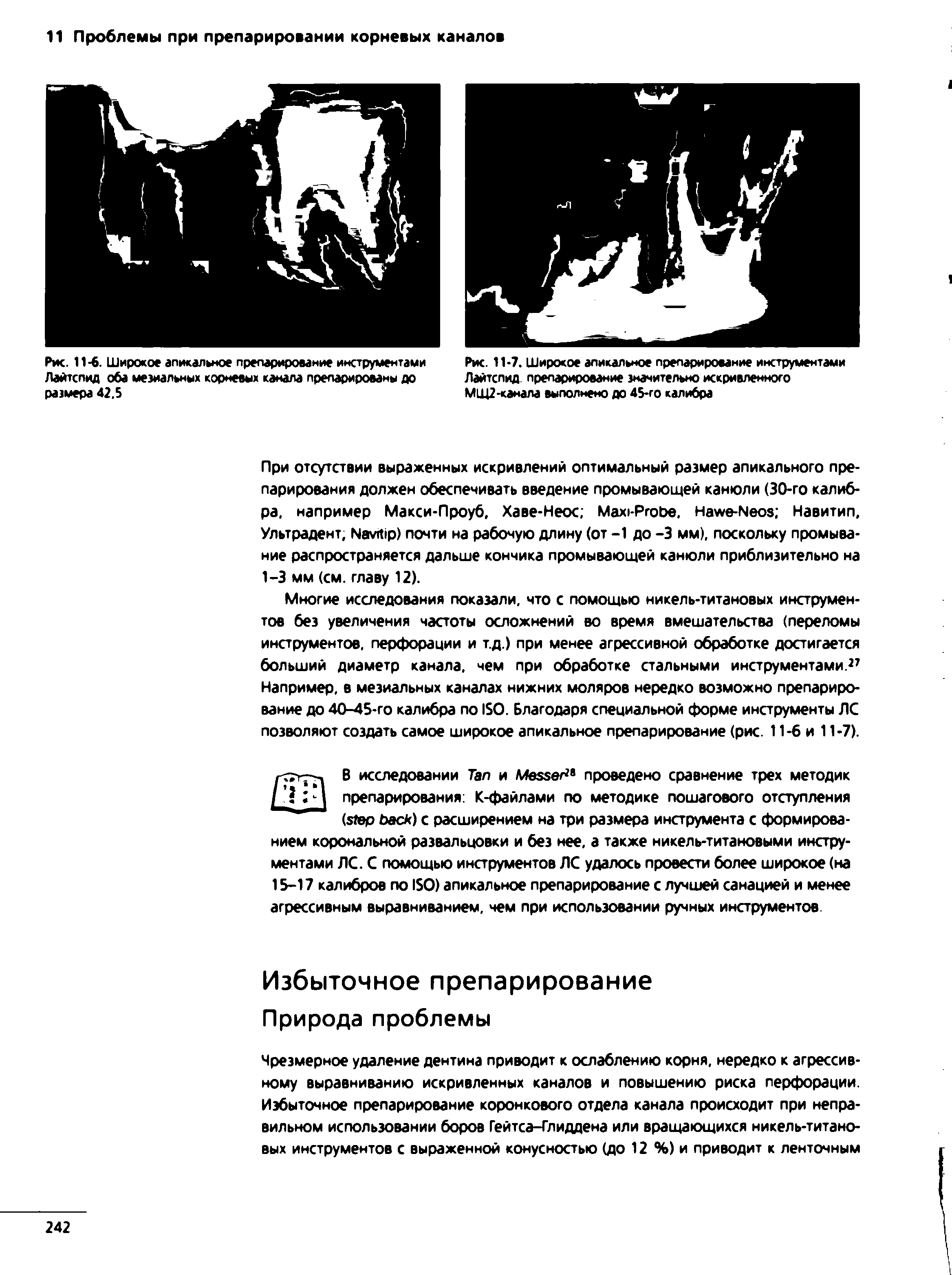 Рис. 11-7. Широкое апикальное препарирование инструментами Лайтспид препарирование значительно искривленного МЩ2-канала выполнено до 45-го калибра...