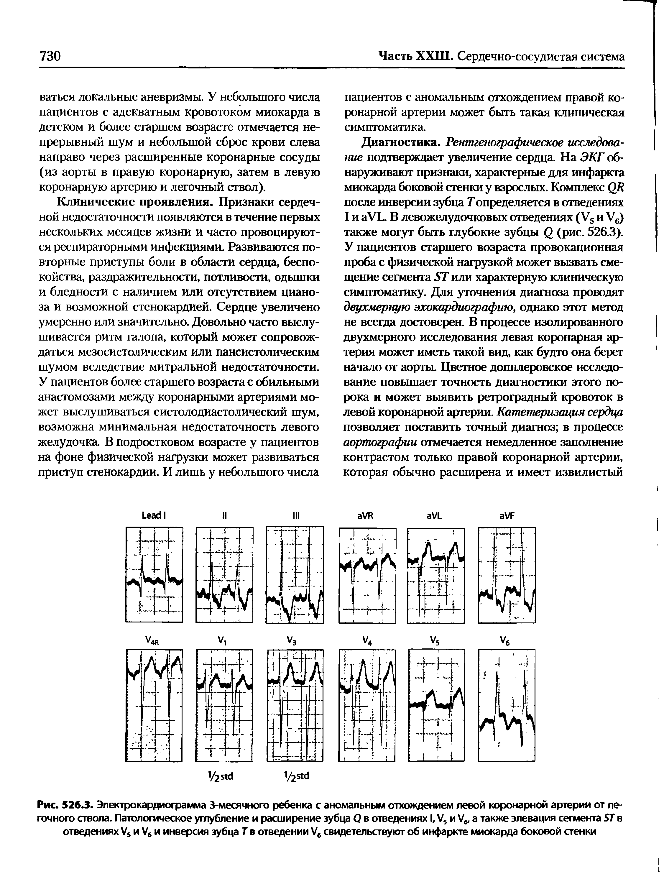 Рис. 526.3. Электрокардиограмма 3-месячного ребенка с аномальным отхождением левой коронарной артерии от легочного ствола. Патологическое углубление и расширение зубца О в отведениях I, V, и а также элевация сегмента 5Г в отведениях /5 и У6 и инверсия зубца Т в отведении свидетельствуют об инфаркте миокарда боковой стенки...