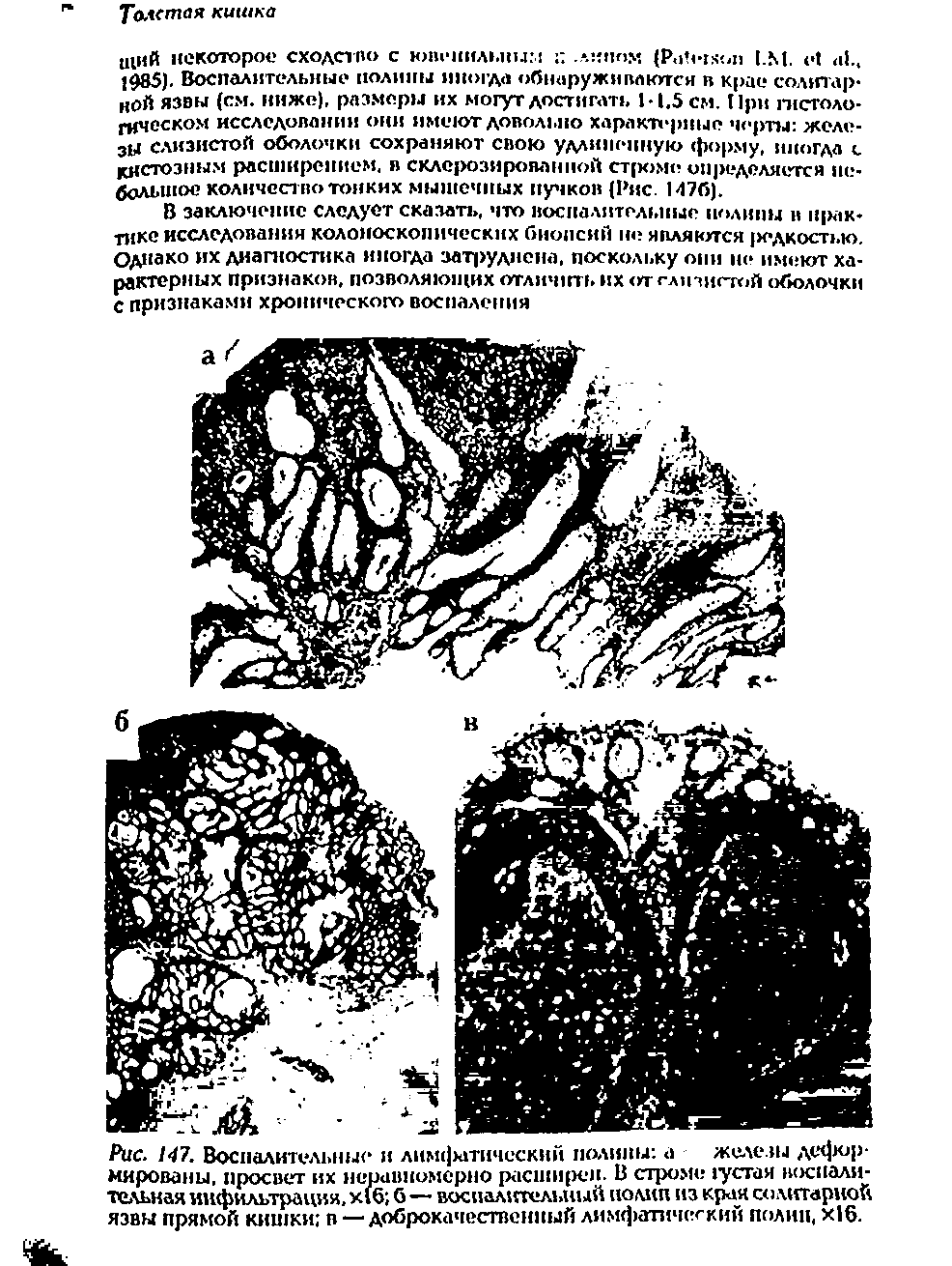 Рис. 147. Воспалительные и лим( атическнй полипы а железы деформированы, просвет их неравномерно расширен. В строме густая воспалительная инфильтрация, х(б б—воспалительный полип из края солитарной язвы прямой кишки в — доброкачественный лимфатический полип, х 6.