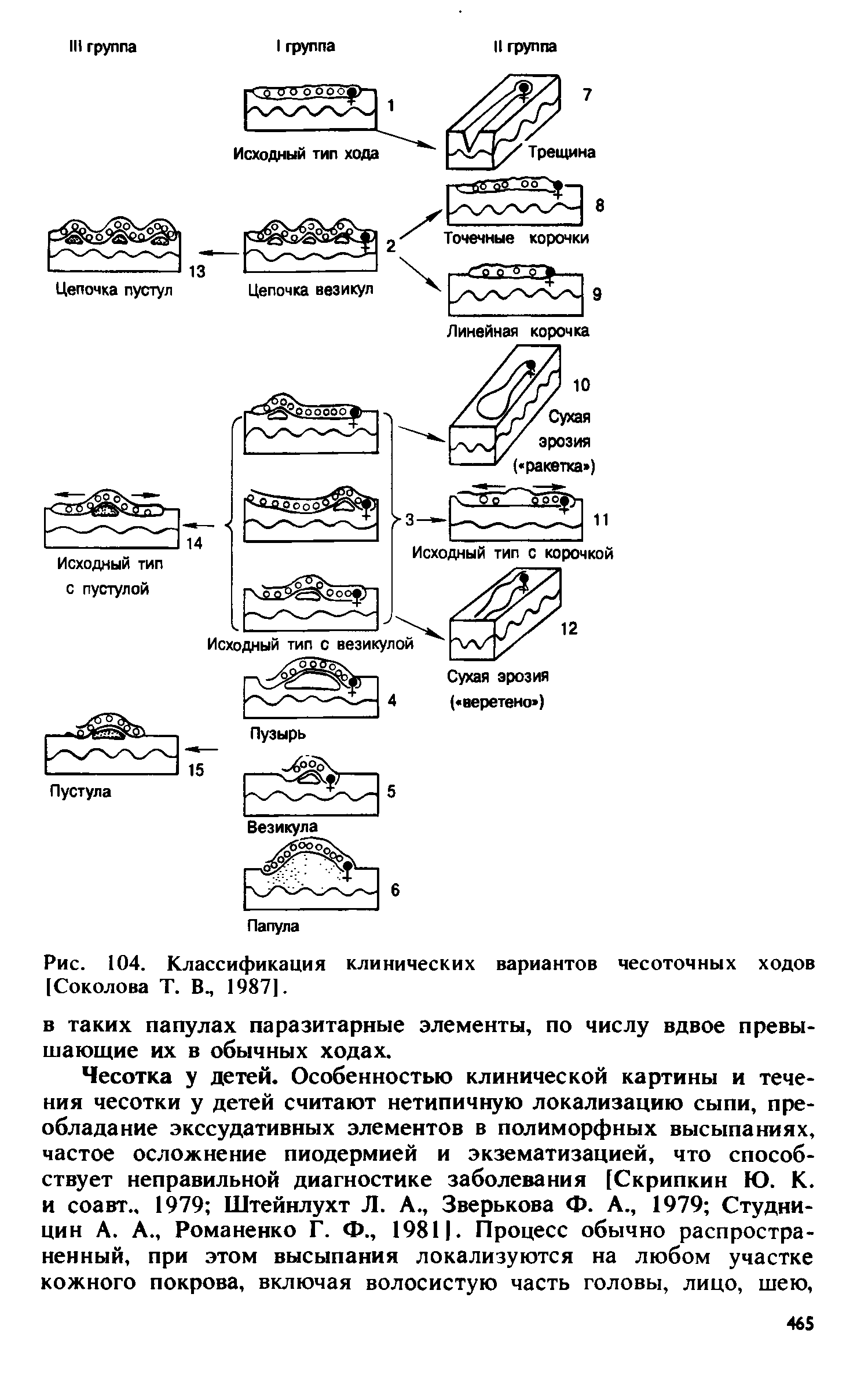 Рис. 104. Классификация клинических вариантов чесоточных ходов [Соколова Т. В., 1987].