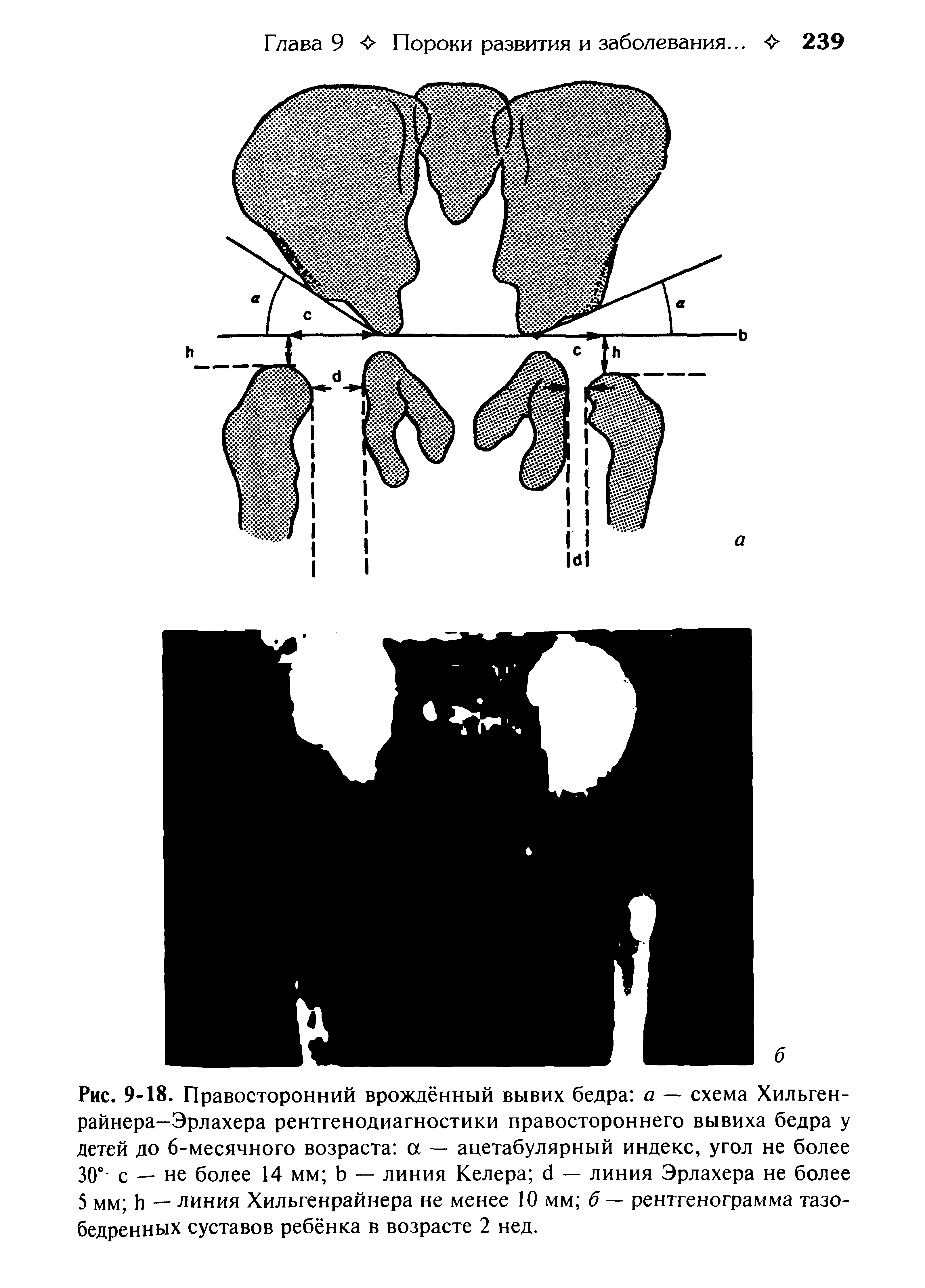 Рис. 9-18. Правосторонний врождённый вывих бедра а — схема Хильген-райнера-Эрлахера рентгенодиагностики правостороннего вывиха бедра у детей до 6-месячного возраста а — ацетабулярный индекс, угол не более 30° с — не более 14 мм Ь — линия Келера б — линия Эрлахера не более 5 мм Ь — линия Хильгенрайнера не менее 10 мм б — рентгенограмма тазобедренных суставов ребёнка в возрасте 2 нед.