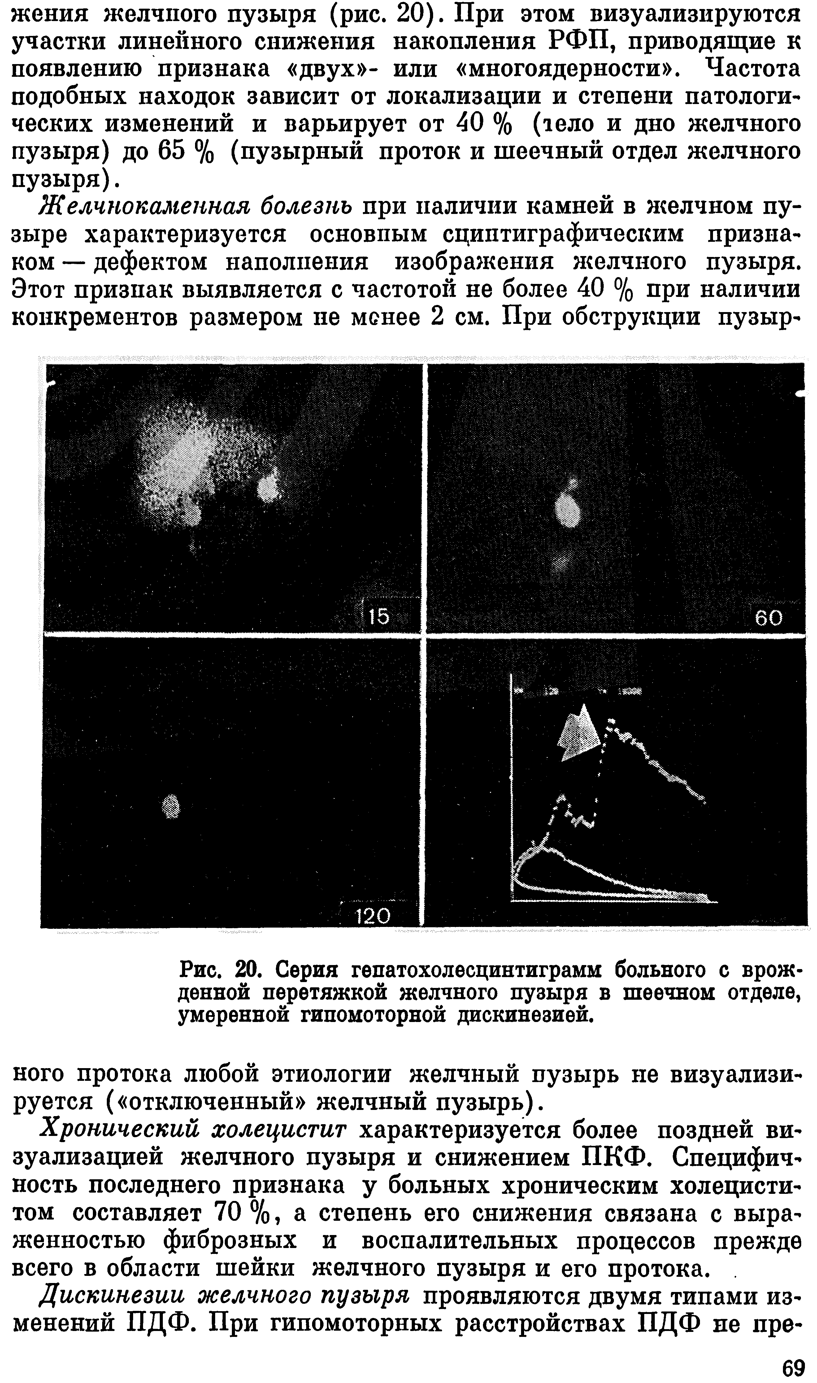 Рис. 20. Серия гепатохолесцинтиграмм больного с врожденной перетяжкой желчного пузыря в шеечном отделе, умеренной гипомоторной дискинезией.