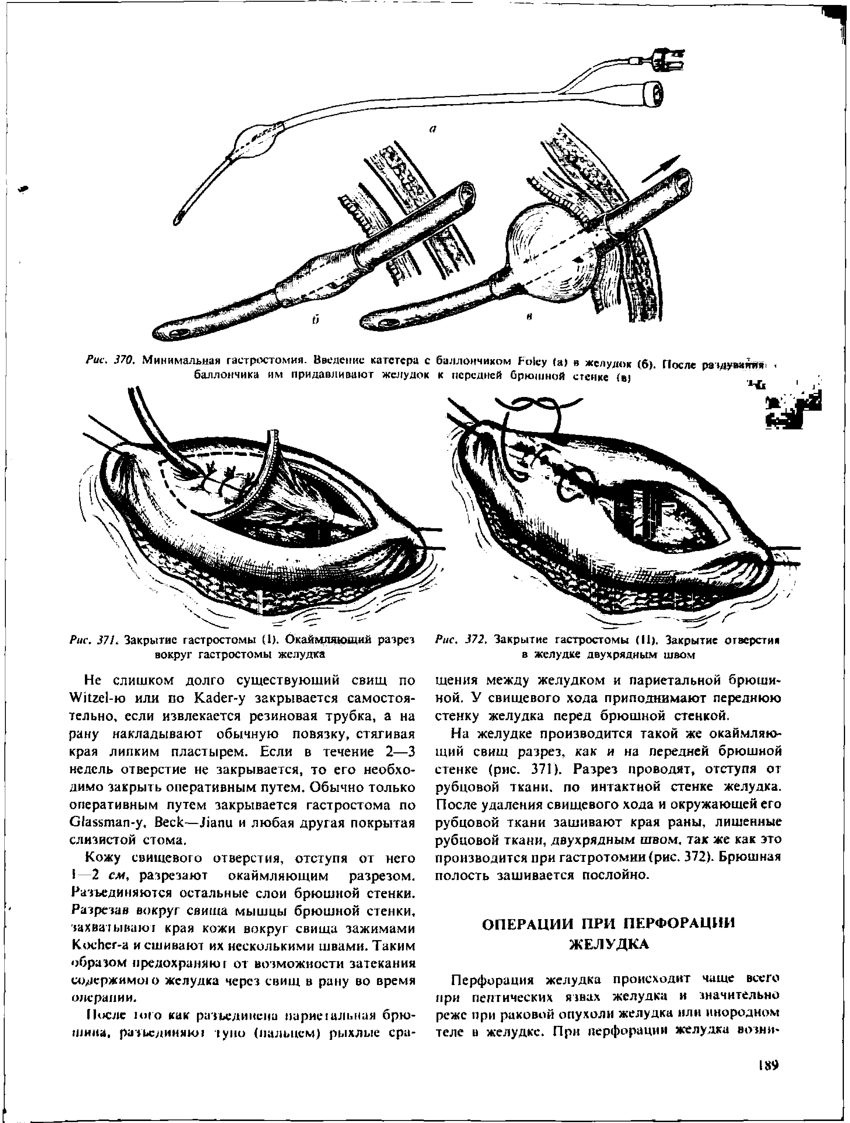 Рис. 370. Минимальная гастростомия. Введение катетера с баллончиком F (а) в желудок (б). После ращу ваттпя баллончика им придавливают желудок к передней брюшной стенке ( ...