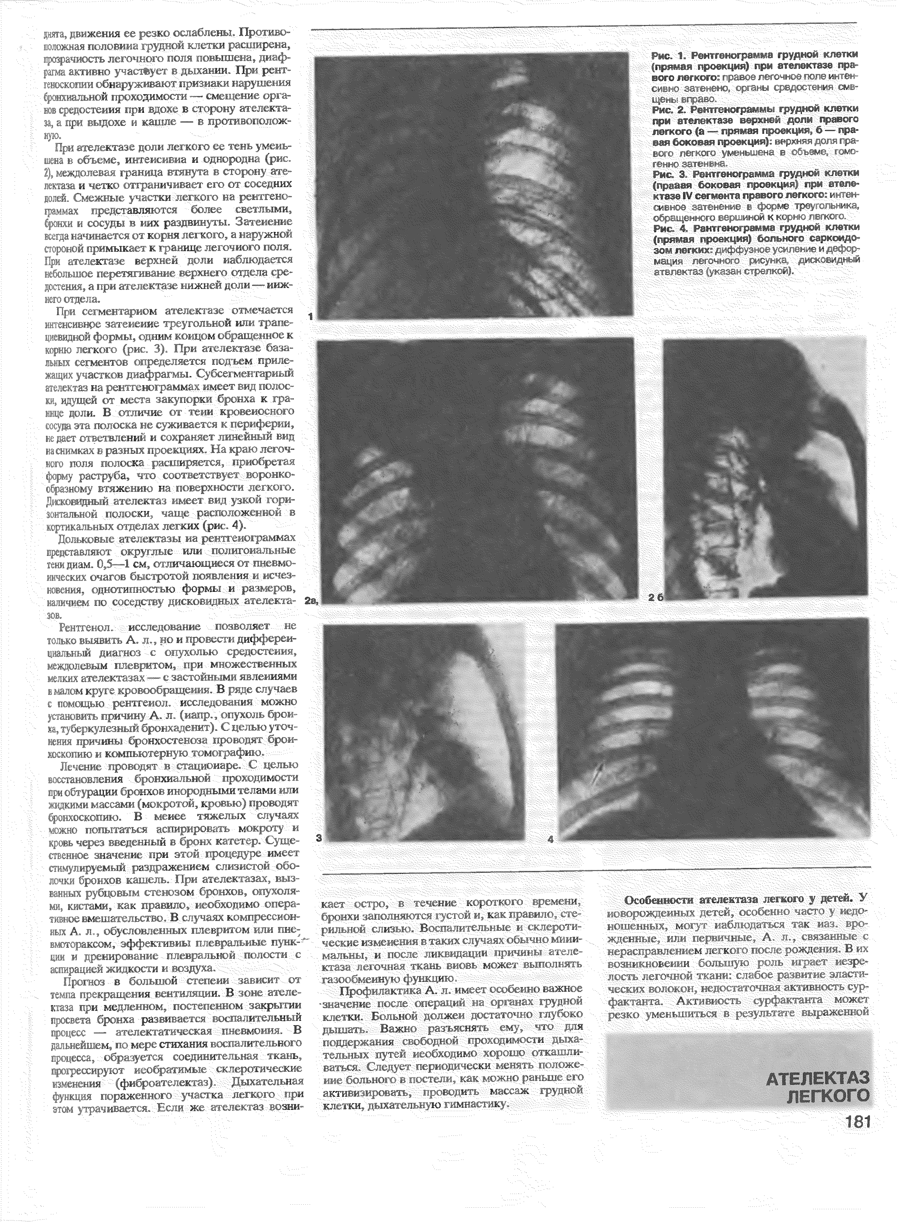 Рис. 1. Рентгенограмма грудной клетки (прямая проекция) при ателектазе правого легкого правое легочное поле интенсивно затенено, органы. V < >.