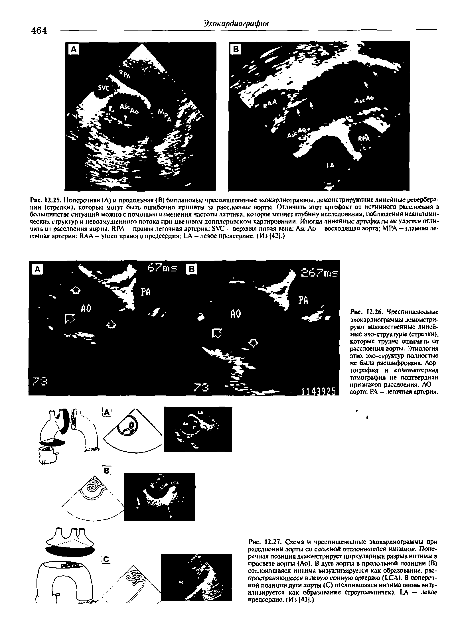 Рис. 12.26. Чреспищеводные эхокардиограммы демонстрируют множественные линейные эхо-структуры (стрелки), которые трудно отличить от расслоения аорты, тиалогия этих эхенлруктур палностыо не была расшифрована. Лор тографкя н компьютерная томография не подтвердили признаков расслоения. АО аорта РА — легочная артерия.