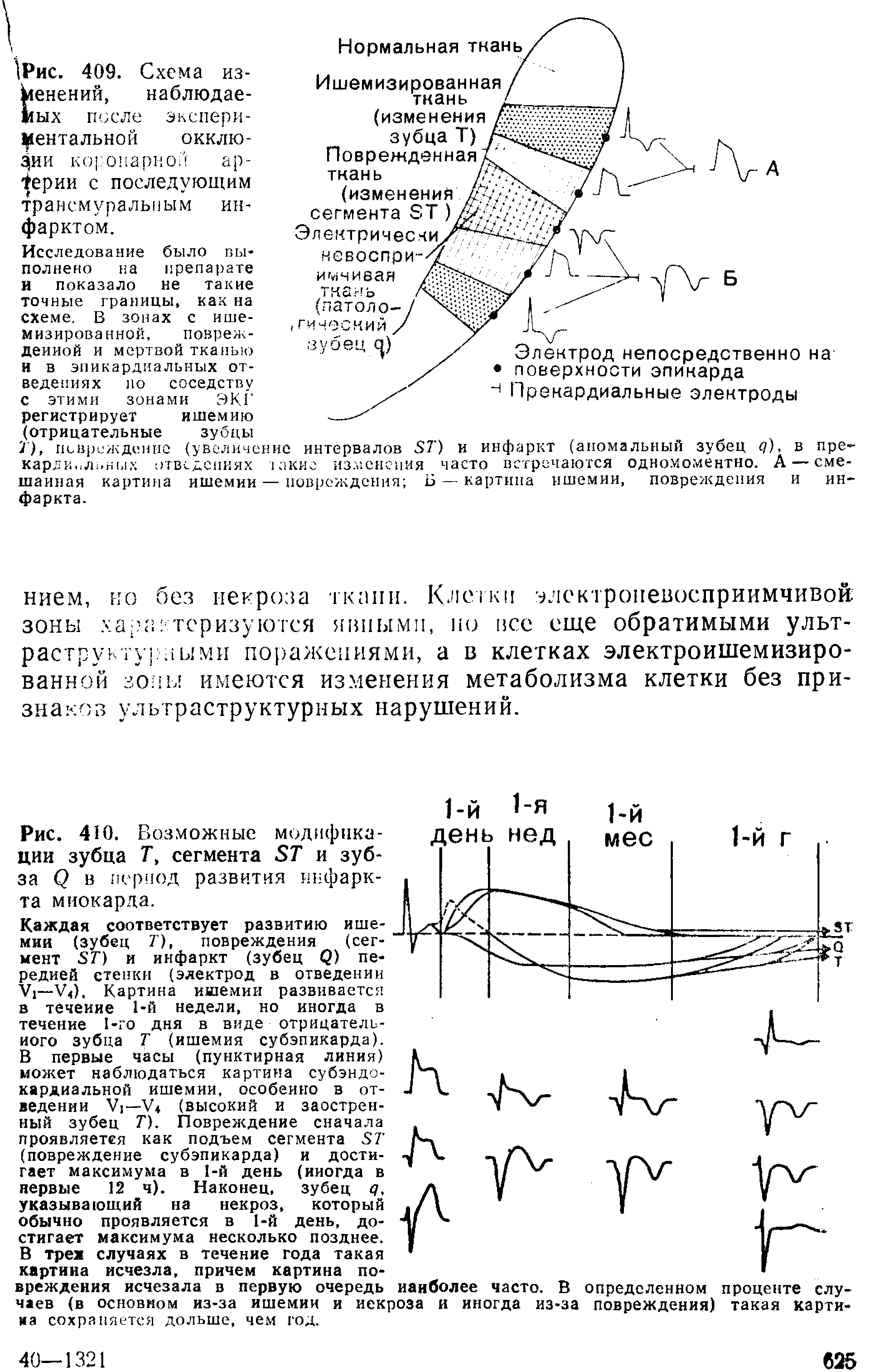 Рис. 410. Возможные модификации зубца Т, сегмента и зуб-за () в период развития инфаркта миокарда.