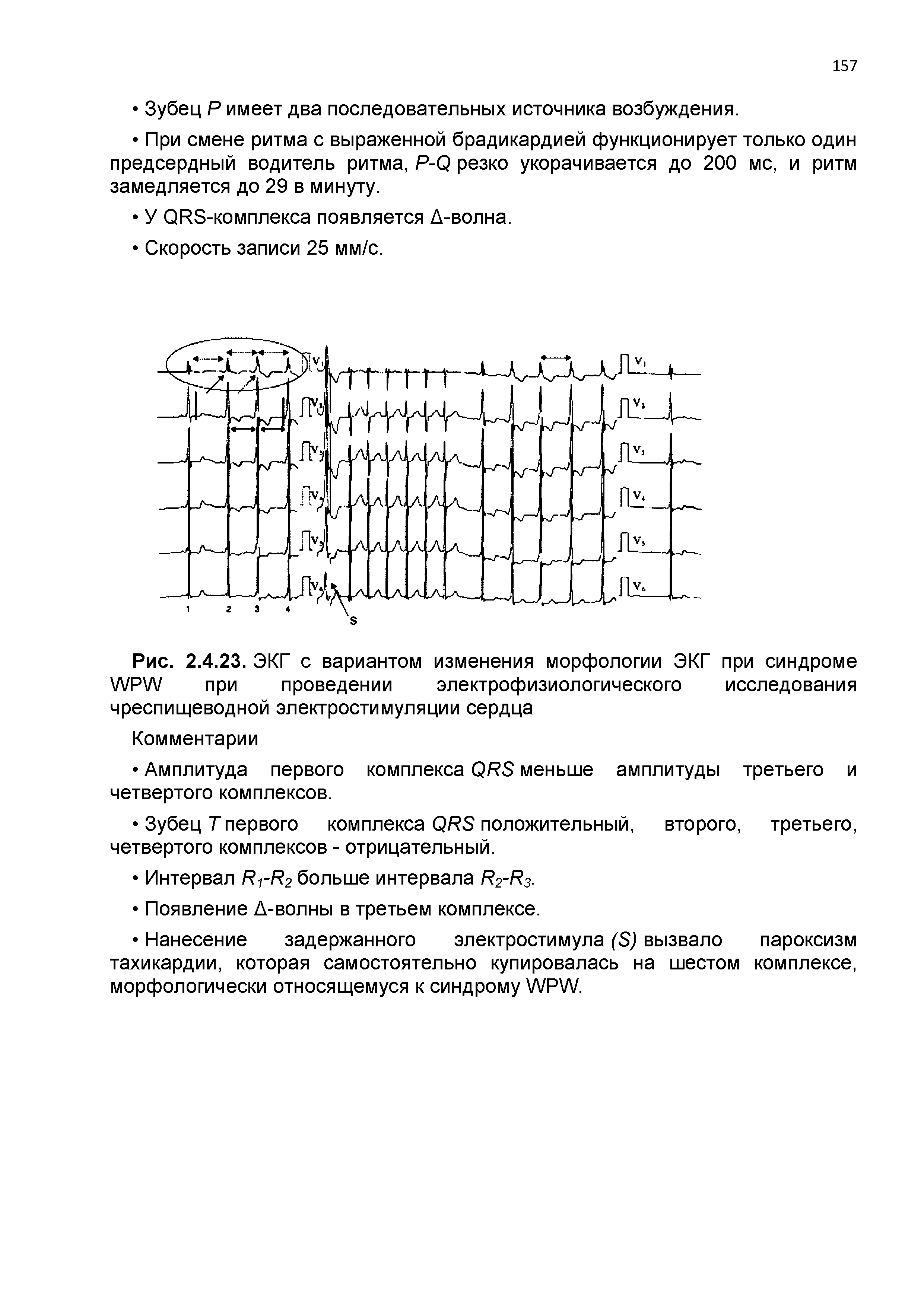 Рис. 2.4.23. ЭКГ с вариантом изменения морфологии ЭКГ при синдроме Л/Р Л/ при проведении электрофизиологического исследования чреспищеводной электростимуляции сердца...