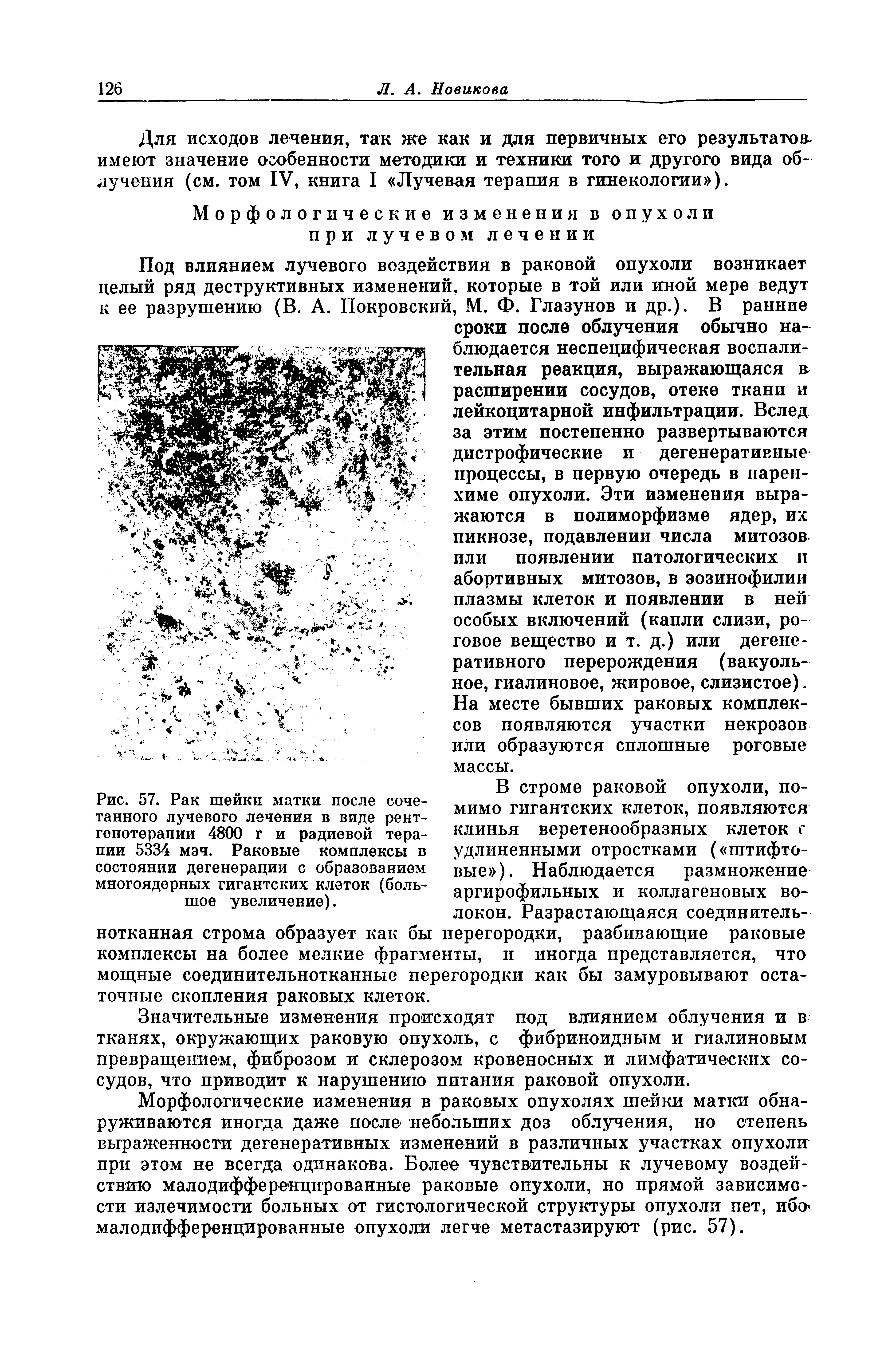 Рис. 57. Рак тайного лучевого лечения в виде генотерапии 4800 г и радиевой пии 5334 мэч. Раковые комплексы в состоянии дегенерации с образованием многоядерных гигантских клеток (большое увеличение).