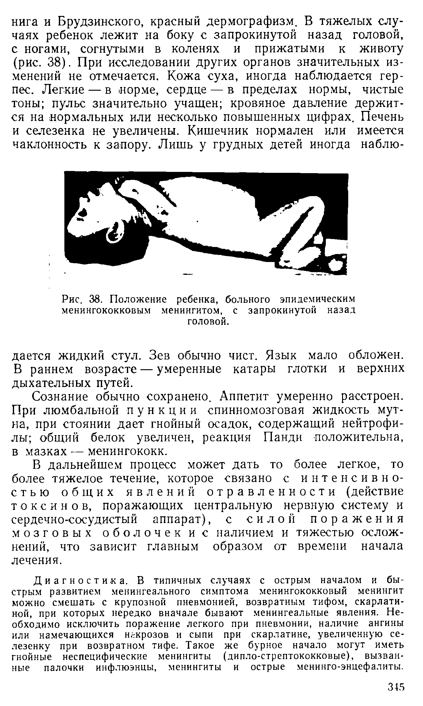 Рис. 38. Положение ребенка, больного эпидемическим менингококковым менингитом, с запрокинутой назад головой.