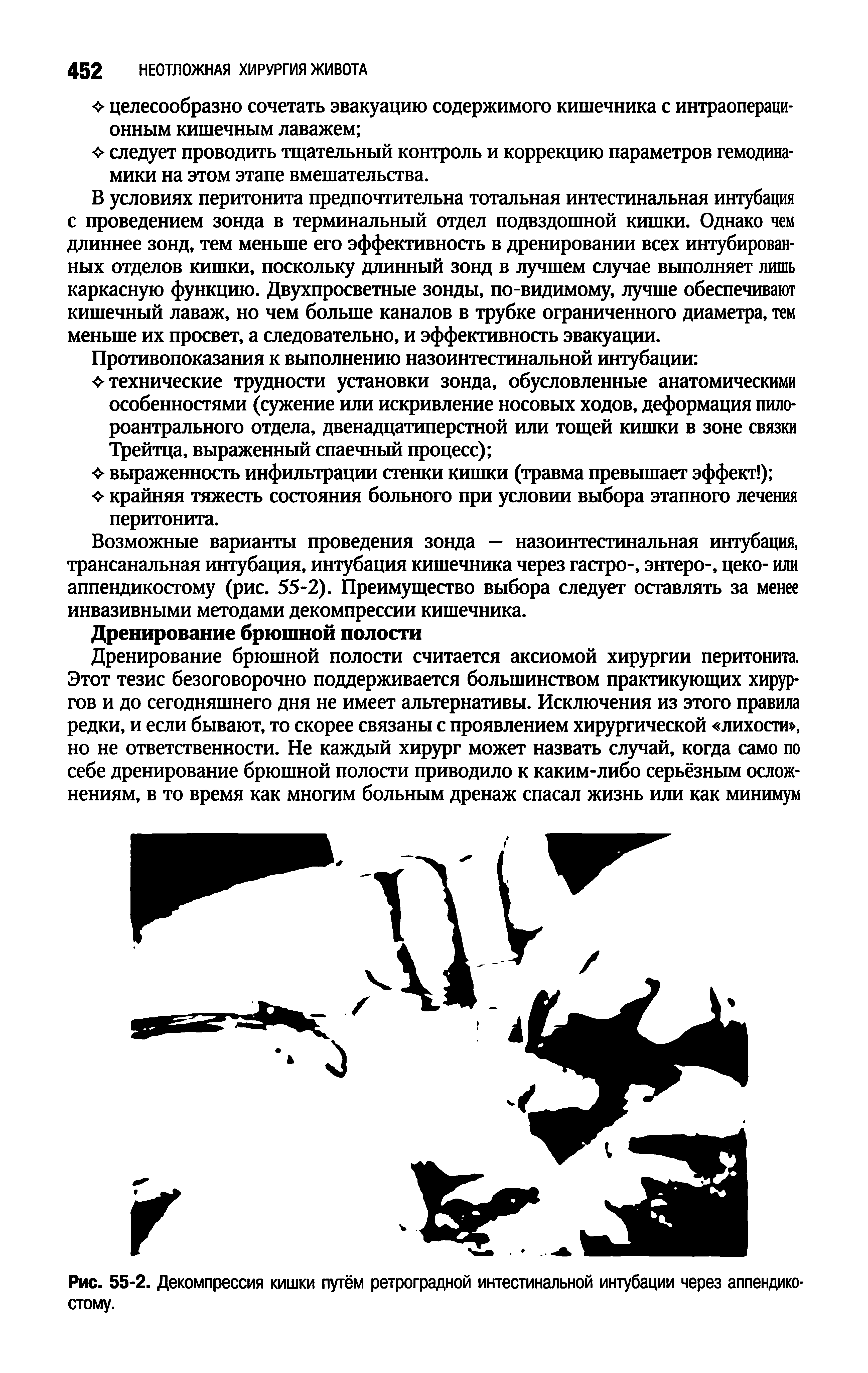 Рис. 55-2. Декомпрессия кишки путём ретроградной интестинальной интубации через аппендикостому.