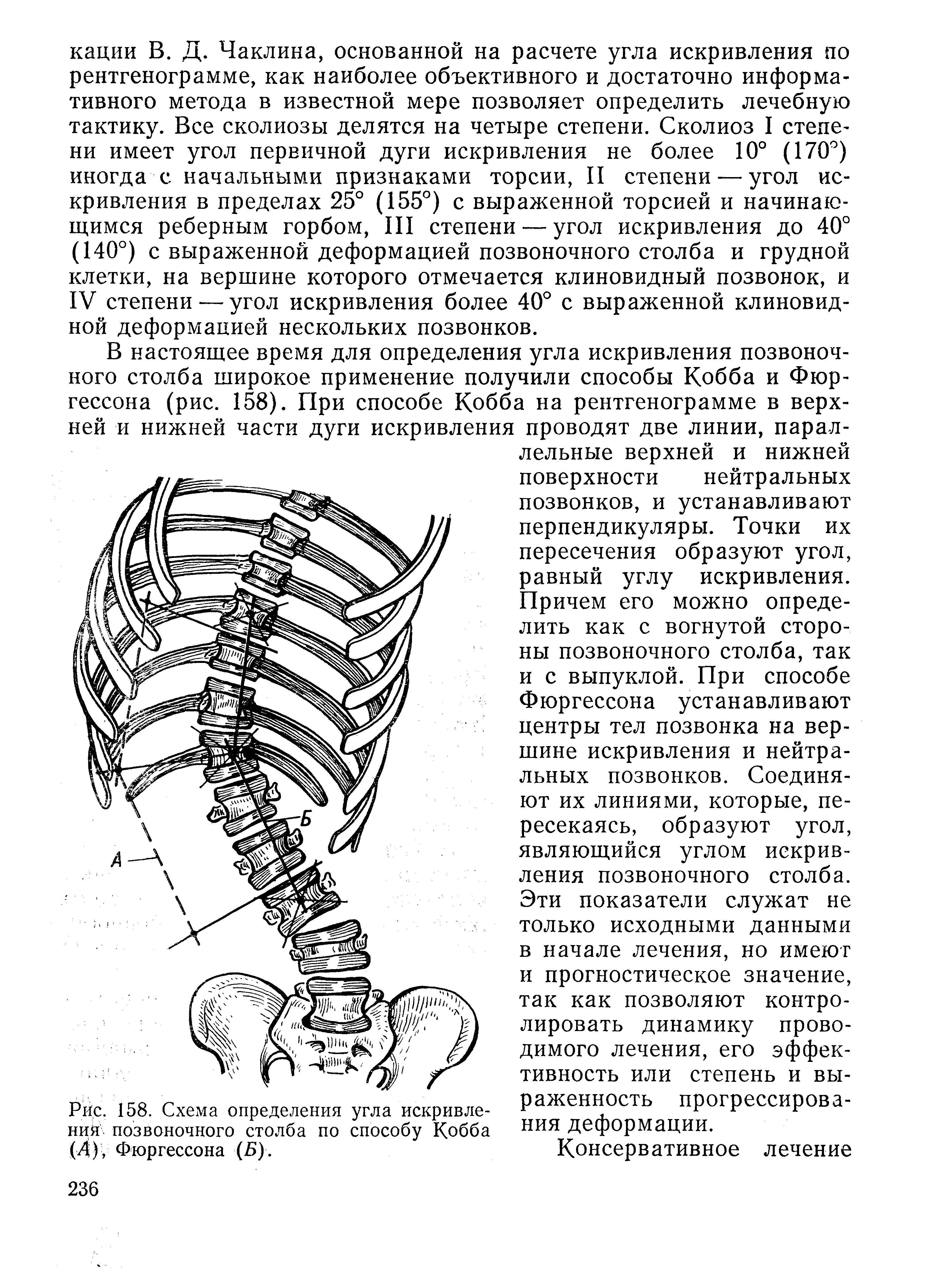 Рис. 158. Схема определения угла искривления позвоночного столба по способу Кобба (Д), Фюргессона (Б).