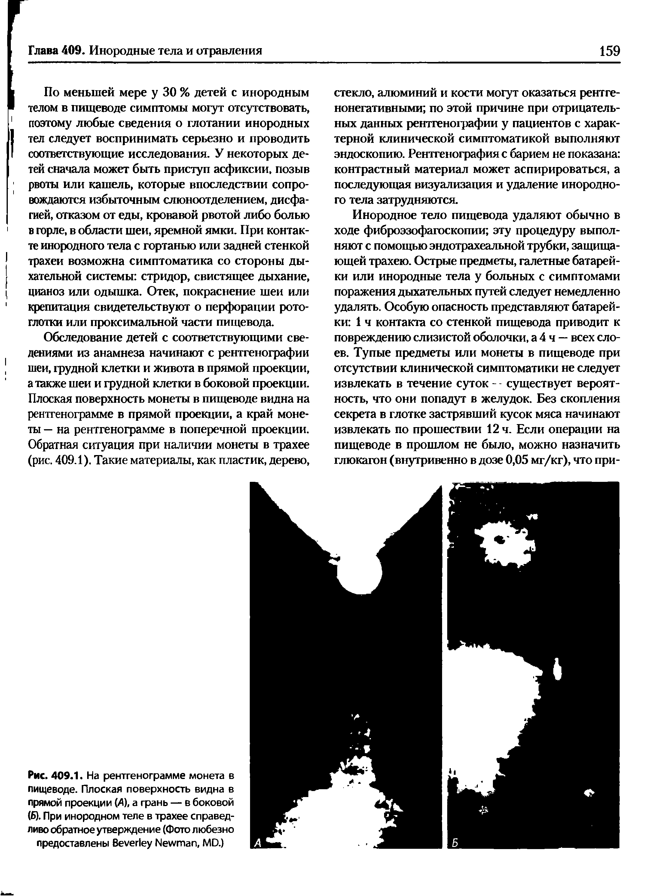 Рис. 409.1. На рентгенограмме монета в пищеводе. Плоская поверхность видна в прямой проекции (4), а грань — в боковой (Б). При инородном теле в трахее справедливо обратное утверждение (Фото любезно предоставлены B N , MD.)...