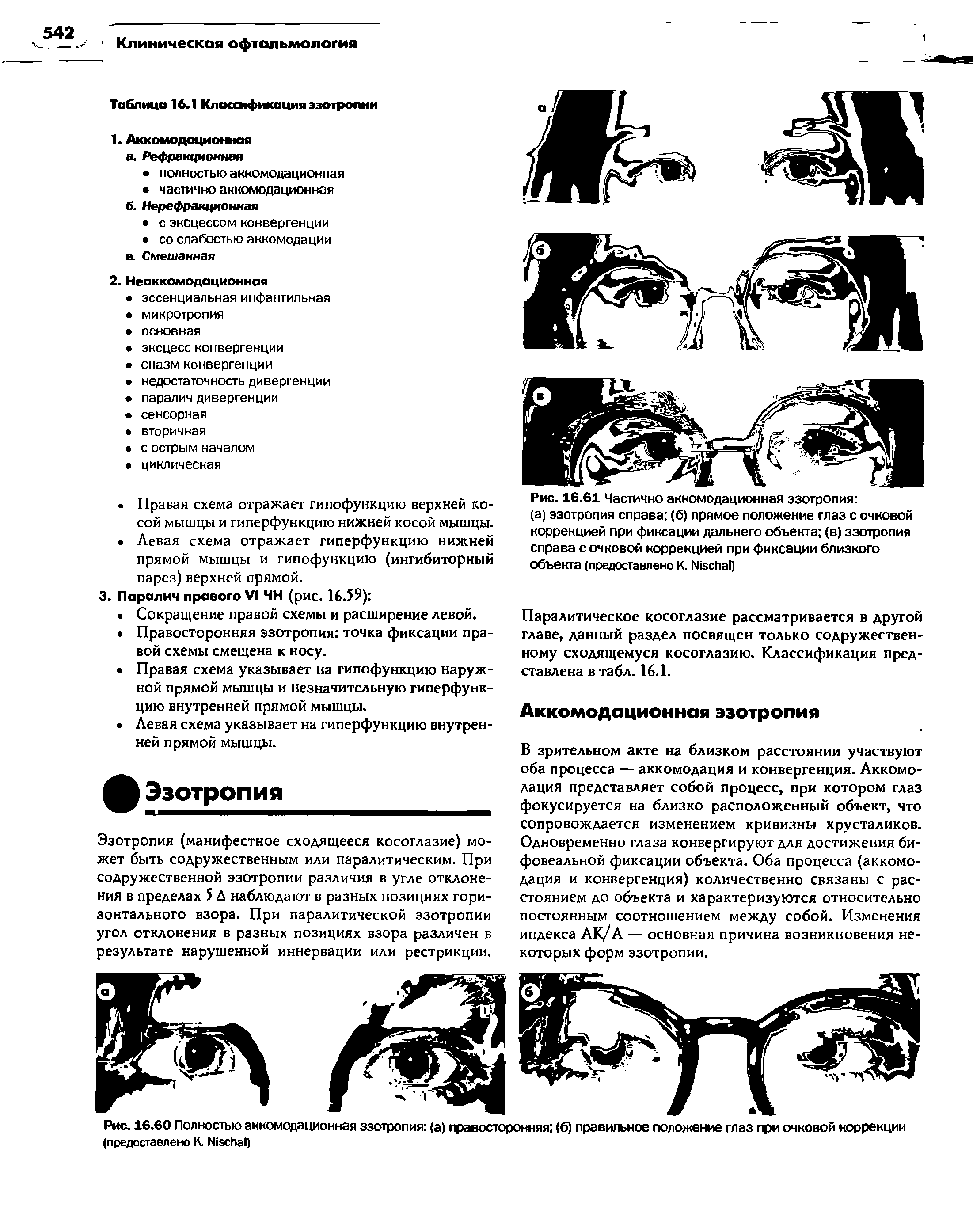 Рис. 16.60 Полностью аккомодационная эзотропия (а) правосторонняя (б) правильное положение глаз при очковой коррекции (предоставлено К Ц 5СИа1)...