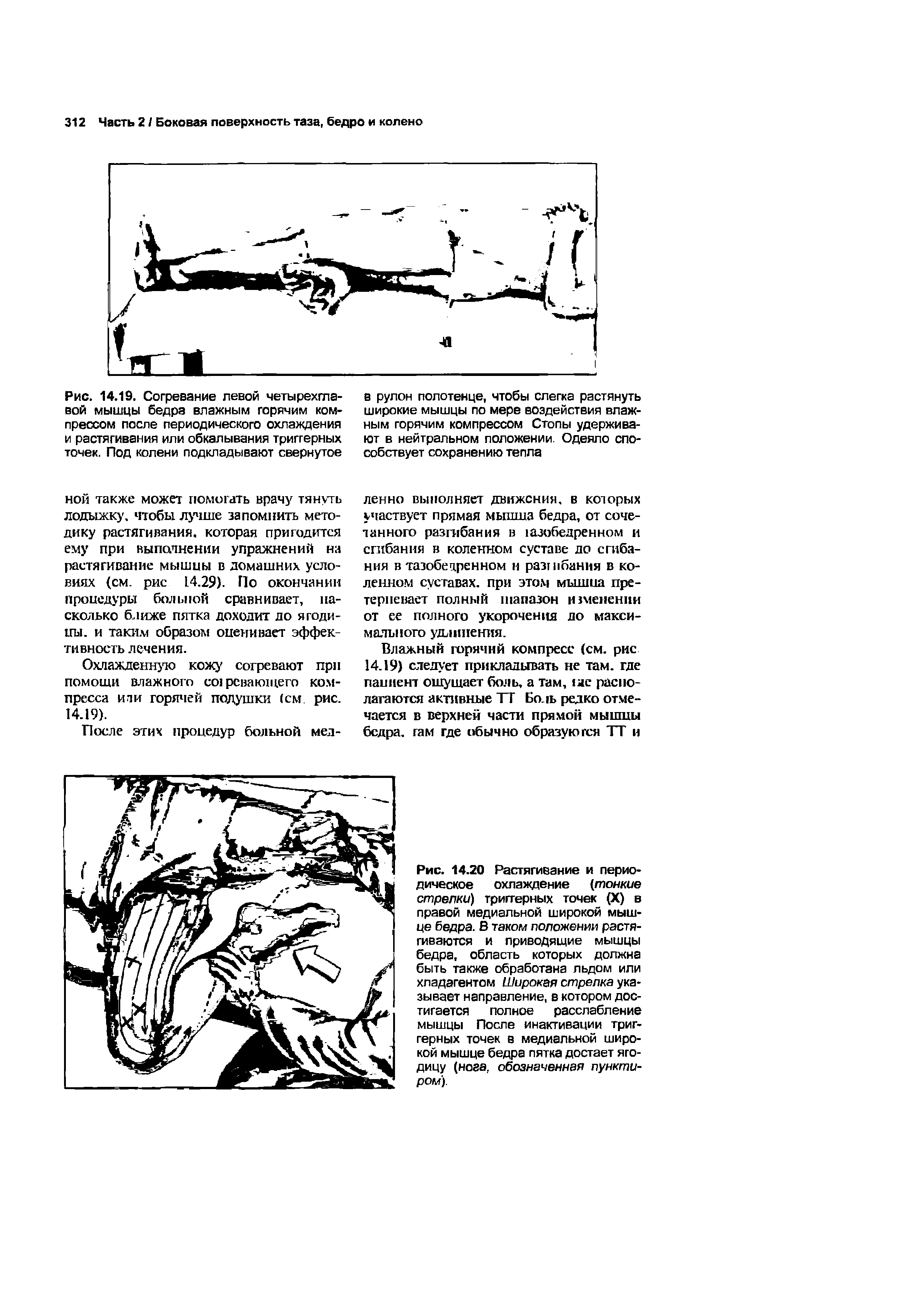 Рис. 14.19. Согревание левой четырехглавой мышцы бедра влажным горячим компрессом после периодического охлаждения и растягивания или обкалывания триггерных точек. Под колени подкладывают свернутое...