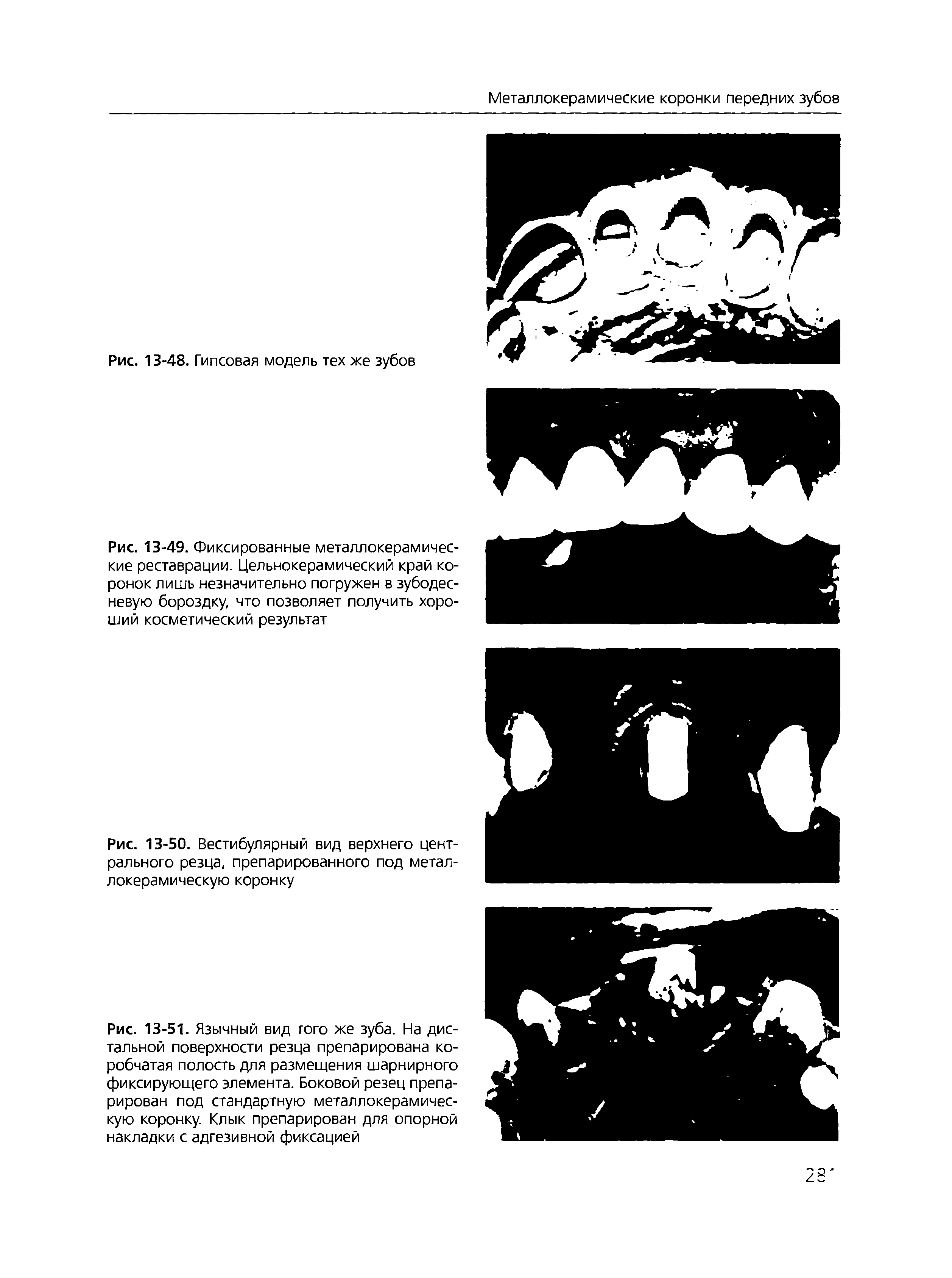 Рис. 13-51. Язычный вид того же зуба. На дистальной поверхности резца препарирована коробчатая полость для размещения шарнирного фиксирующего элемента. Боковой резец препарирован под стандартную металлокерамическую коронку. Клык препарирован для опорной накладки с адгезивной фиксацией...