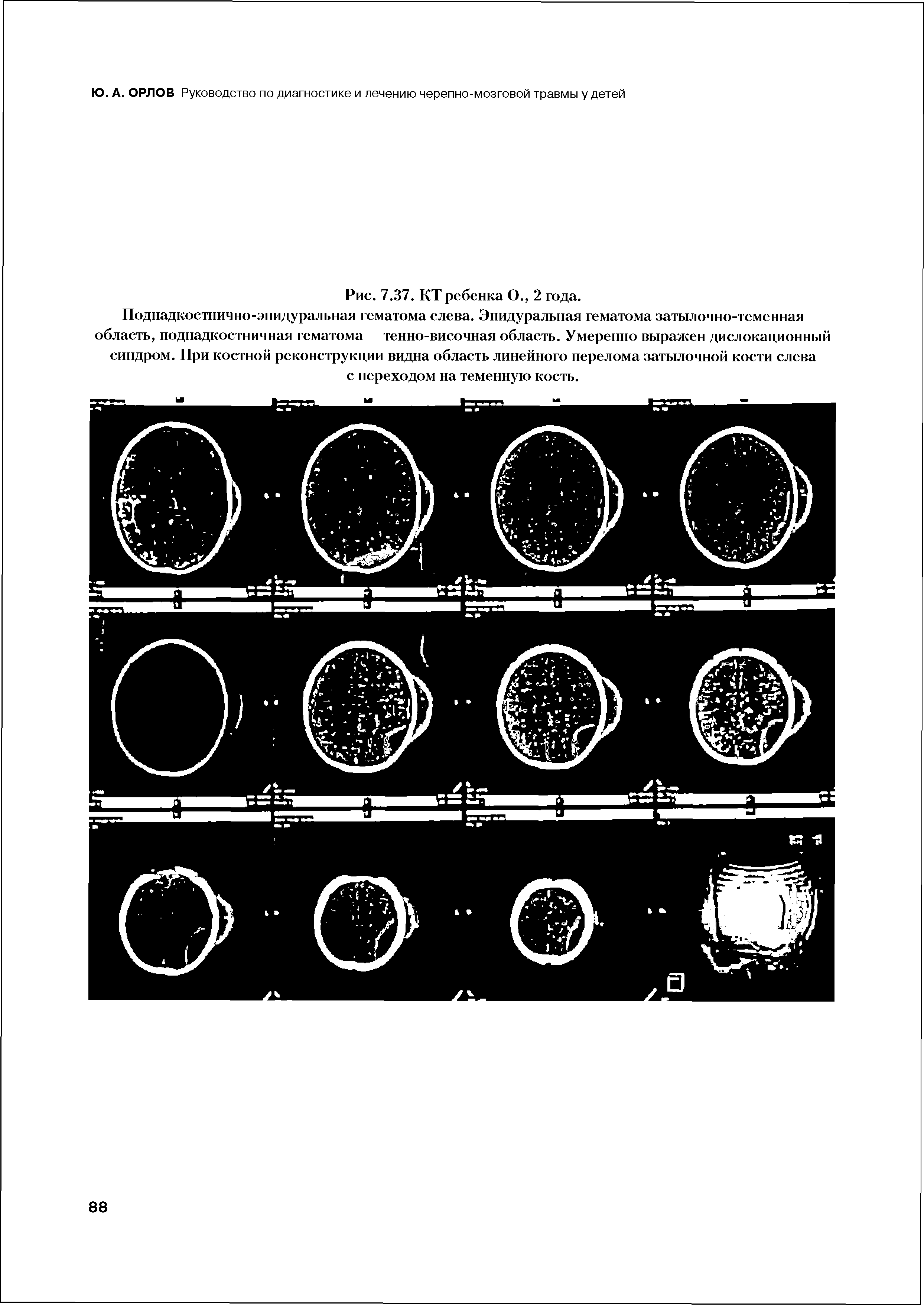 Рис. 7.37. КТ ребенка О., 2 года. Поднадкостнично-эпидуральная гематома слева. Эпидуральная гематома затылочно-теменная область, поднадкостничная гематома тенно-височная область. Умеренно выражен дислокационный синдром. При костной реконструкции видна область линейного перелома затылочной кости слева с переходом на теменную кость.