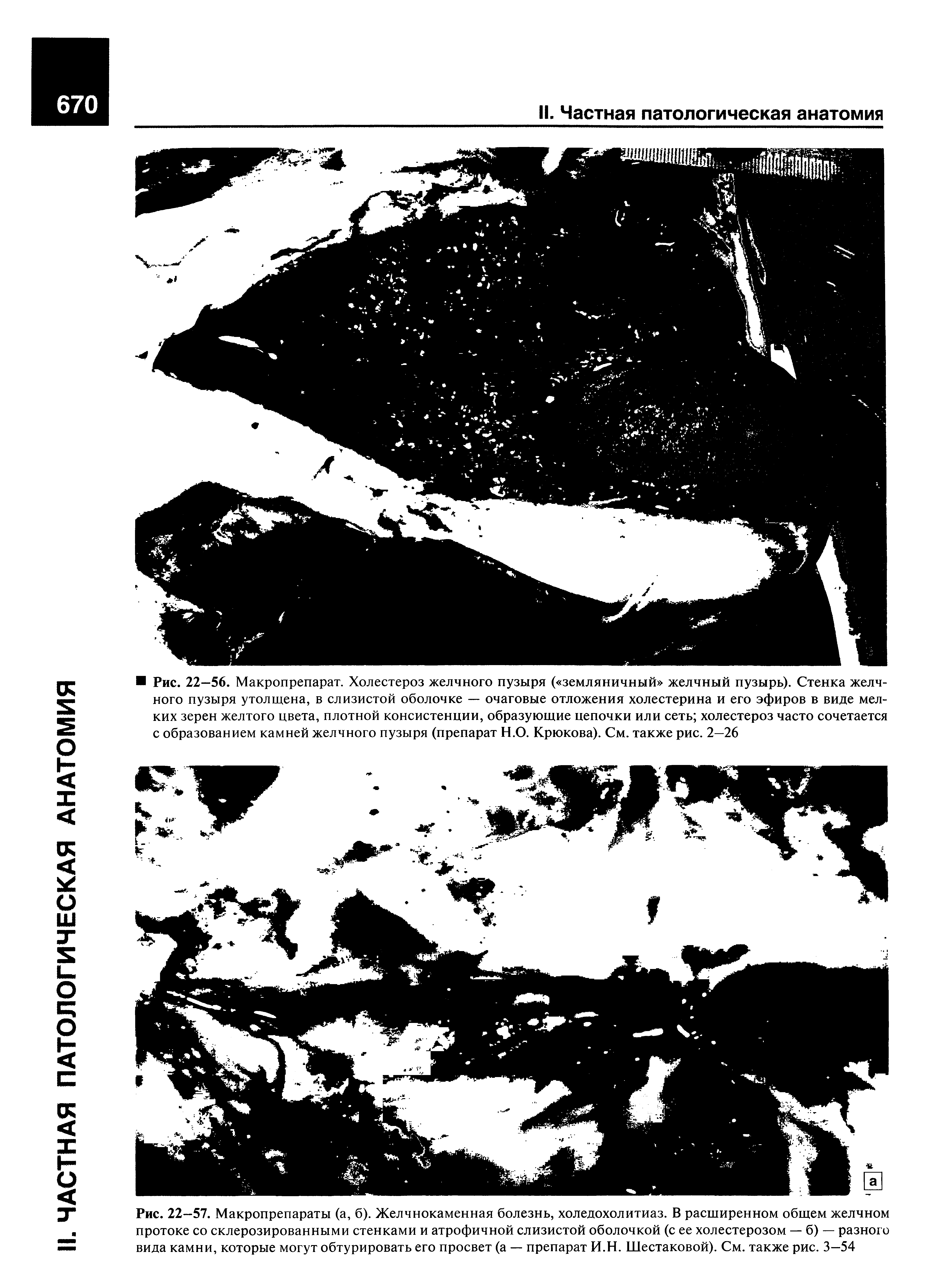 Рис. 22—57. Макропрепараты (а, б). Желчнокаменная болезнь, холедохолитиаз. В расширенном общем желчном протоке со склерозированными стенками и атрофичной слизистой оболочкой (с ее холестерозом — б) — разного вида камни, которые могут обтурировать его просвет (а — препарат И.Н. Шестаковой). См. также рис. 3—54...