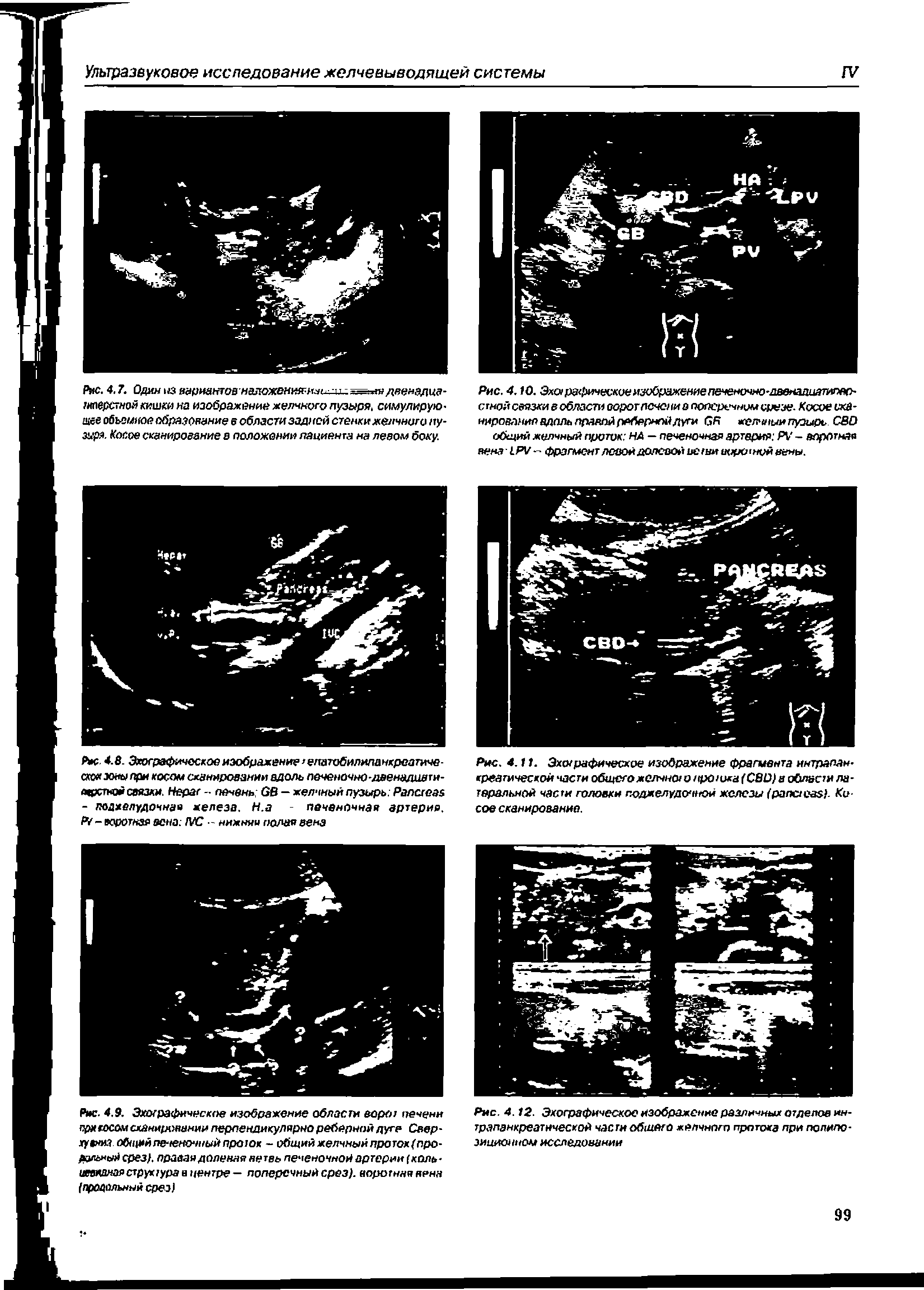 Рис. 4.9. Эхографическое изображение области ворот печени при косом сканировании перпендикулярно реберной дуге Свер-хувниа общийпеченочныйпроюк - общий желчный протох(про-волычхй срез), правая деления ветвь печеночной артерии (коль-иевлдмаяструктуравцентре — поперечный срез), воротная нена (продольный срез)...