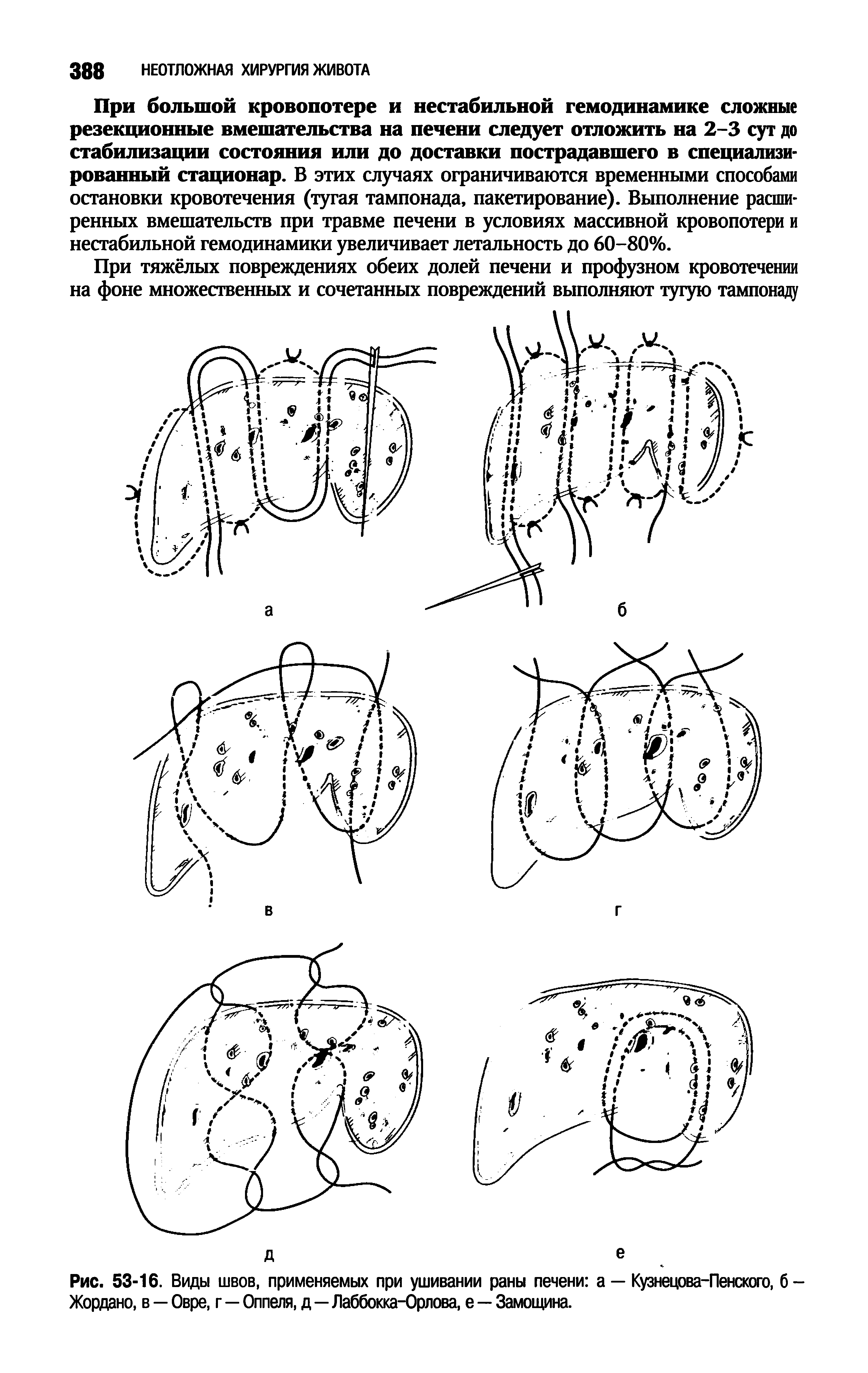Рис. 53-16. Виды швов, применяемых при ушивании раны печени а — Кузнецова-Пенского, б-Жордано, в — Овре, г—Оппеля, д—Лаббокка-Орлова, е — Замощина.