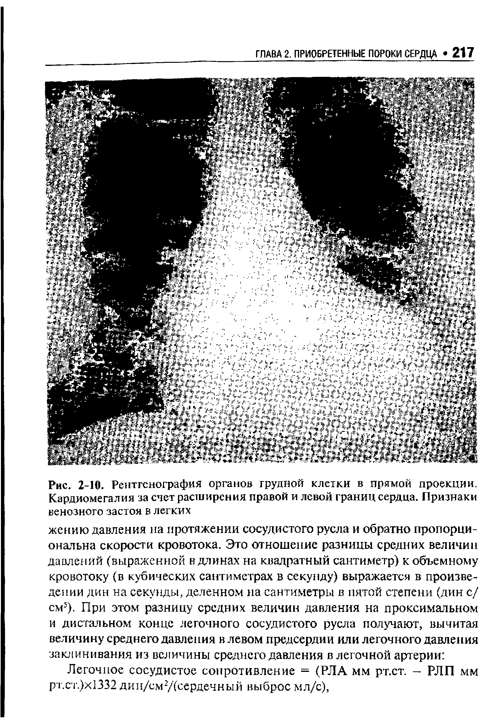 Рис. 2-10. Рентгенография органов грудной клетки в прямой проекции. Кардиомегалия за счет расширения правой и левой границ сердца. Признаки венозного застоя в легких...