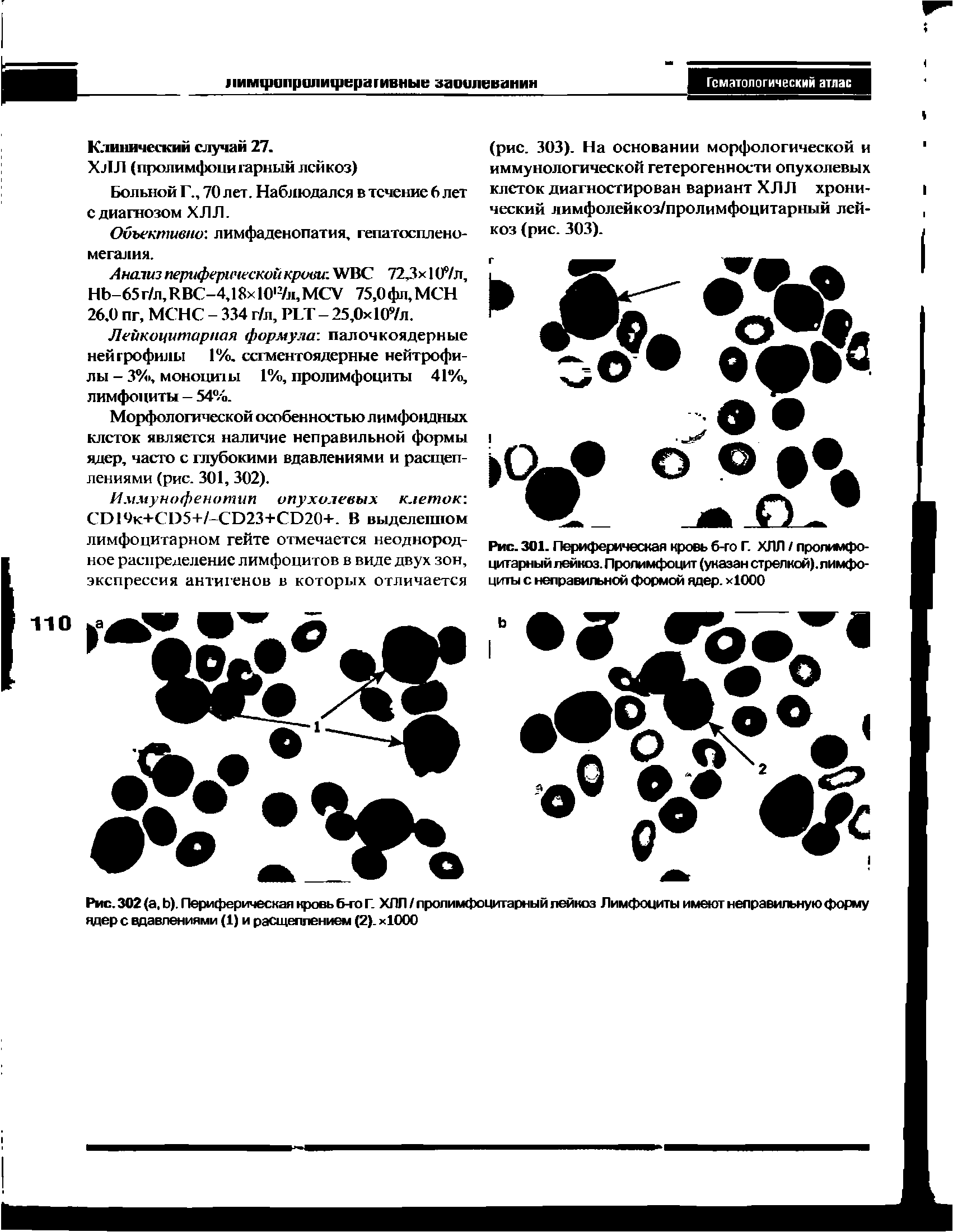 Рис. 301. Периферическая кровь б-го Г. ХЛЛ / пролимфо-цитарный лейкоз. Пролимфоцит (унаэан стрелкой), лимфоциты с неправильной формой ядер. х1000...
