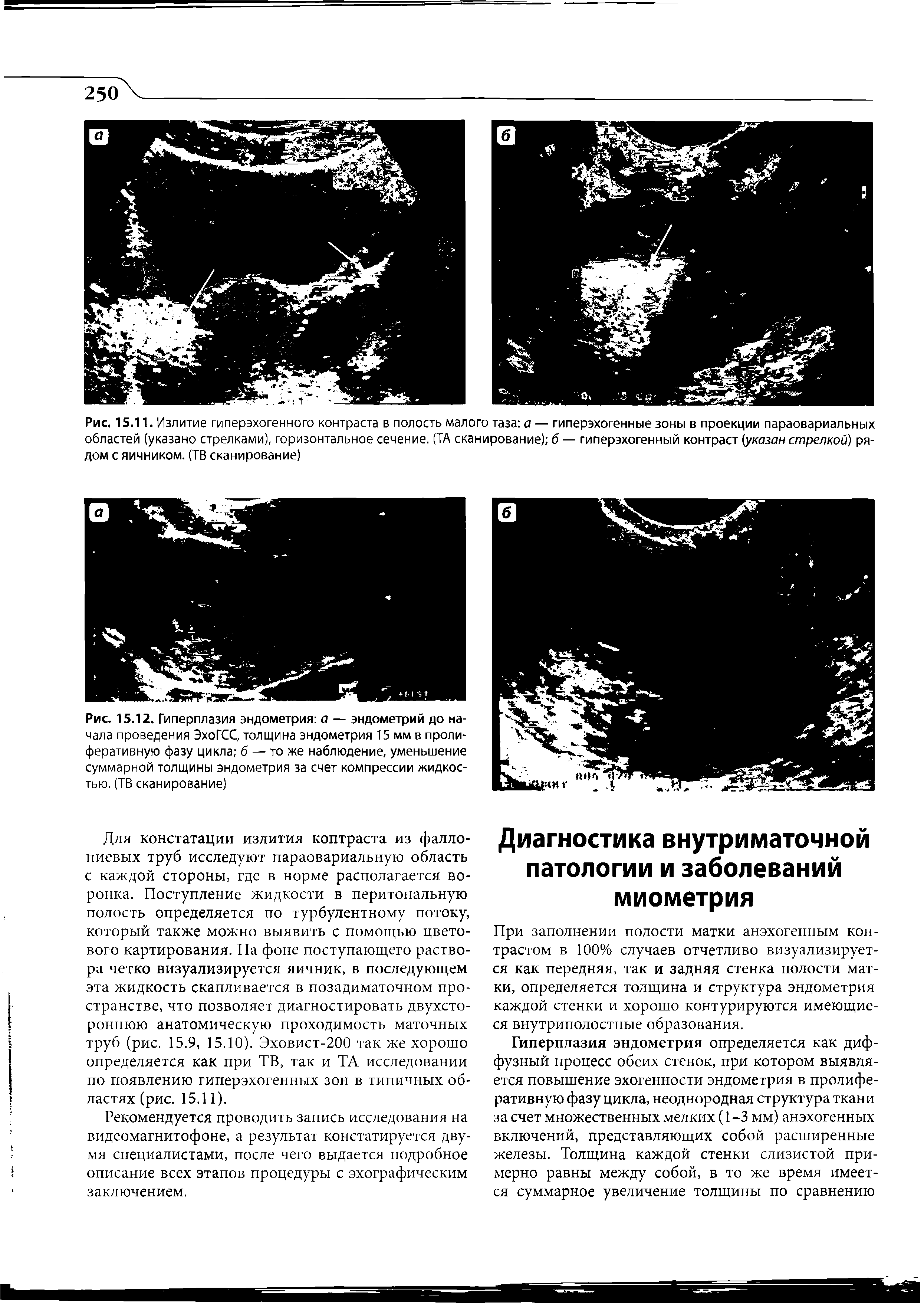Рис. 15.12. Гиперплазия эндометрия а — эндометрий до начала проведения ЭхоГСС, толщина эндометрия 15 мм в пролиферативную фазу цикла б — то же наблюдение, уменьшение суммарной толщины эндометрия за счет компрессии жидкостью. (ТВ сканирование)...