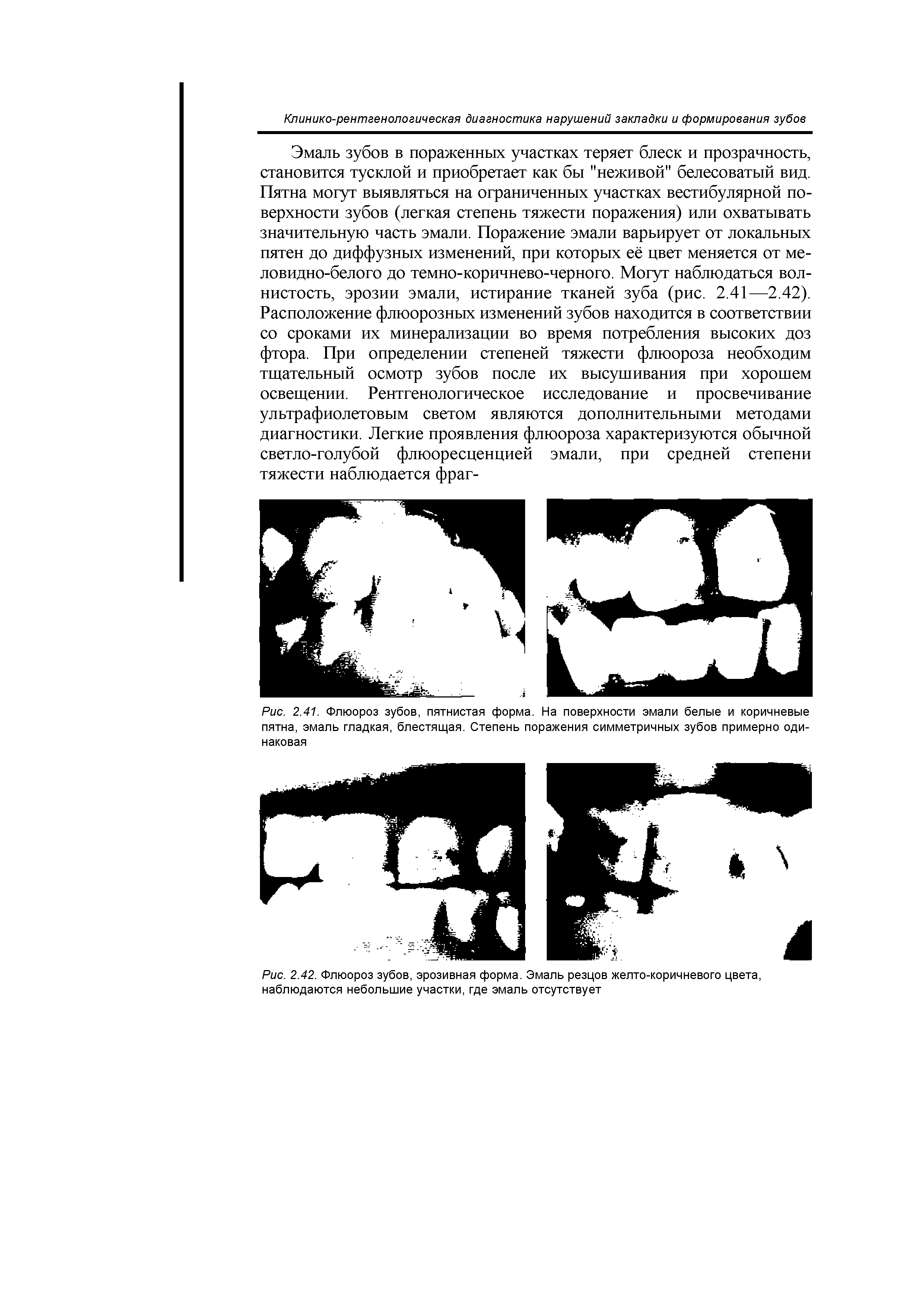 Рис. 2.41. Флюороз зубов, пятнистая форма. На поверхности эмали белые и коричневые пятна, эмаль гладкая, блестящая. Степень поражения симметричных зубов примерно одинаковая...