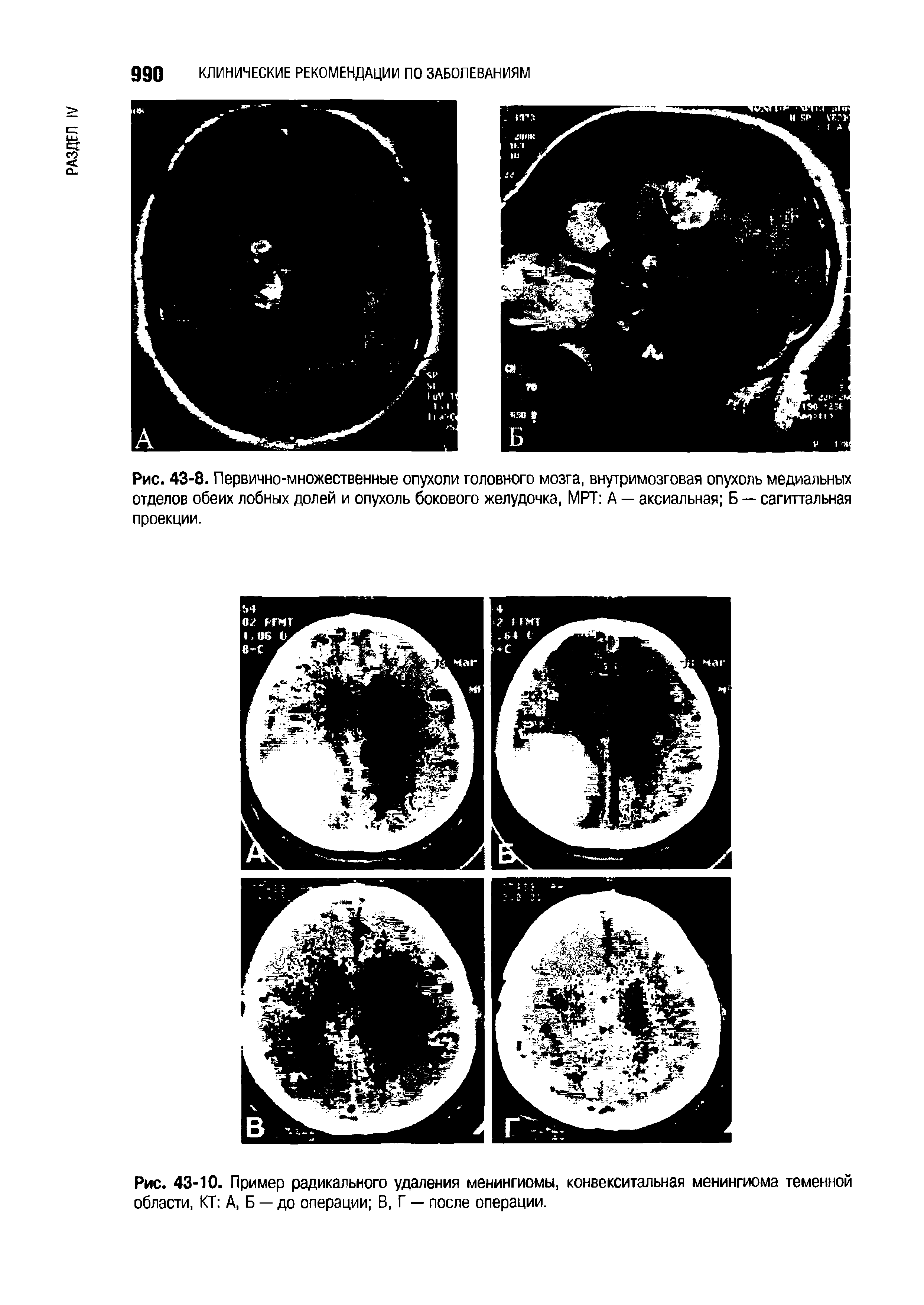 Рис. 43-10. Пример радикального удаления менингиомы, конвекситальная менингиома теменной области, КТ А, Б — до операции В, Г — после операции.