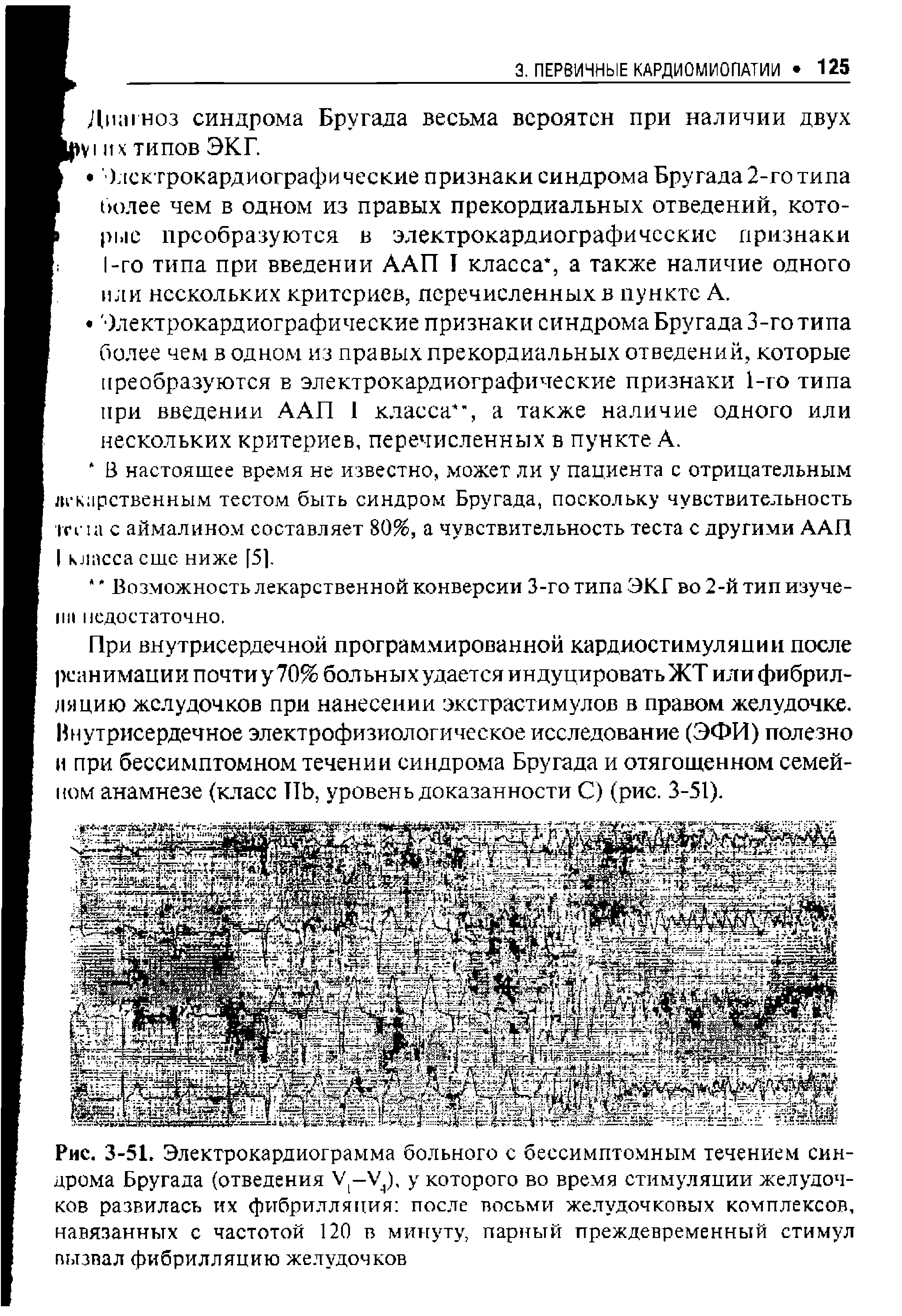 Рис. 3-51. Электрокардиограмма больного с бессимптомным течением синдрома Бругада (отведения У-У,), у которого во время стимуляции желудочков развилась их фибрилляция после восьми желудочковых комплексов, навязанных с частотой 120 в минуту, парный преждевременный стимул вызвал фибрилляцию желудочков...