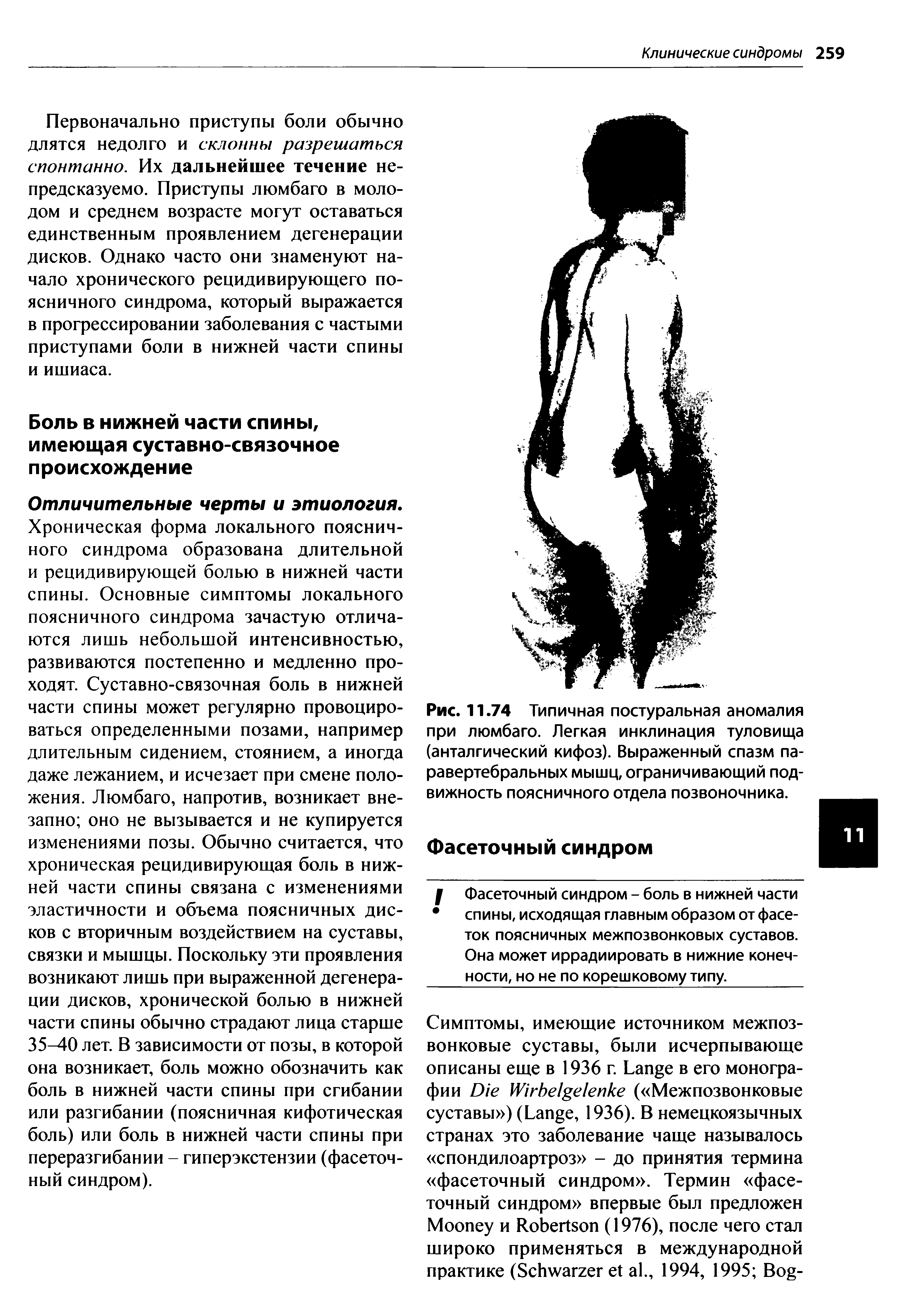 Рис. 11.74 Типичная постуральная аномалия при люмбаго. Легкая инклинация туловища (анталгический кифоз). Выраженный спазм паравертебральных мышц, ограничивающий подвижность поясничного отдела позвоночника.