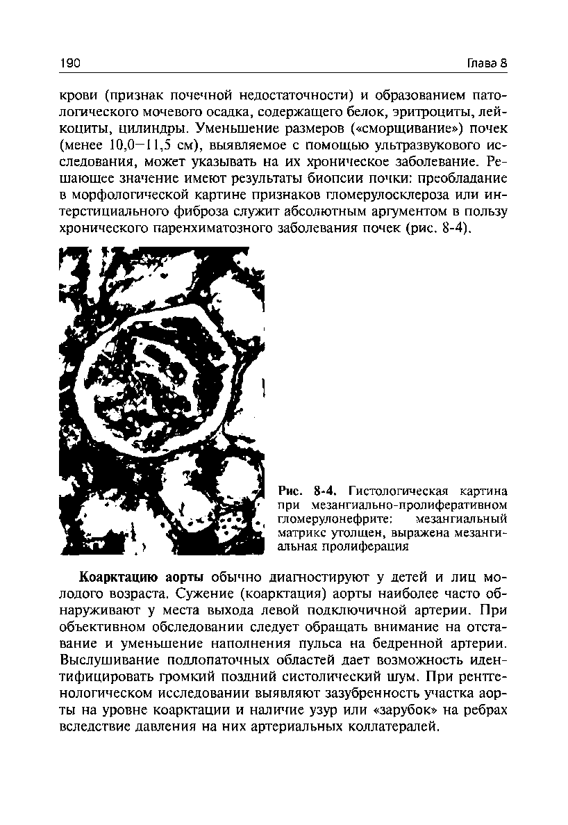 Рис. 8-4. Гистологическая картина при мезангиально-пролиферативном гломерулонефрите мезангиальный...