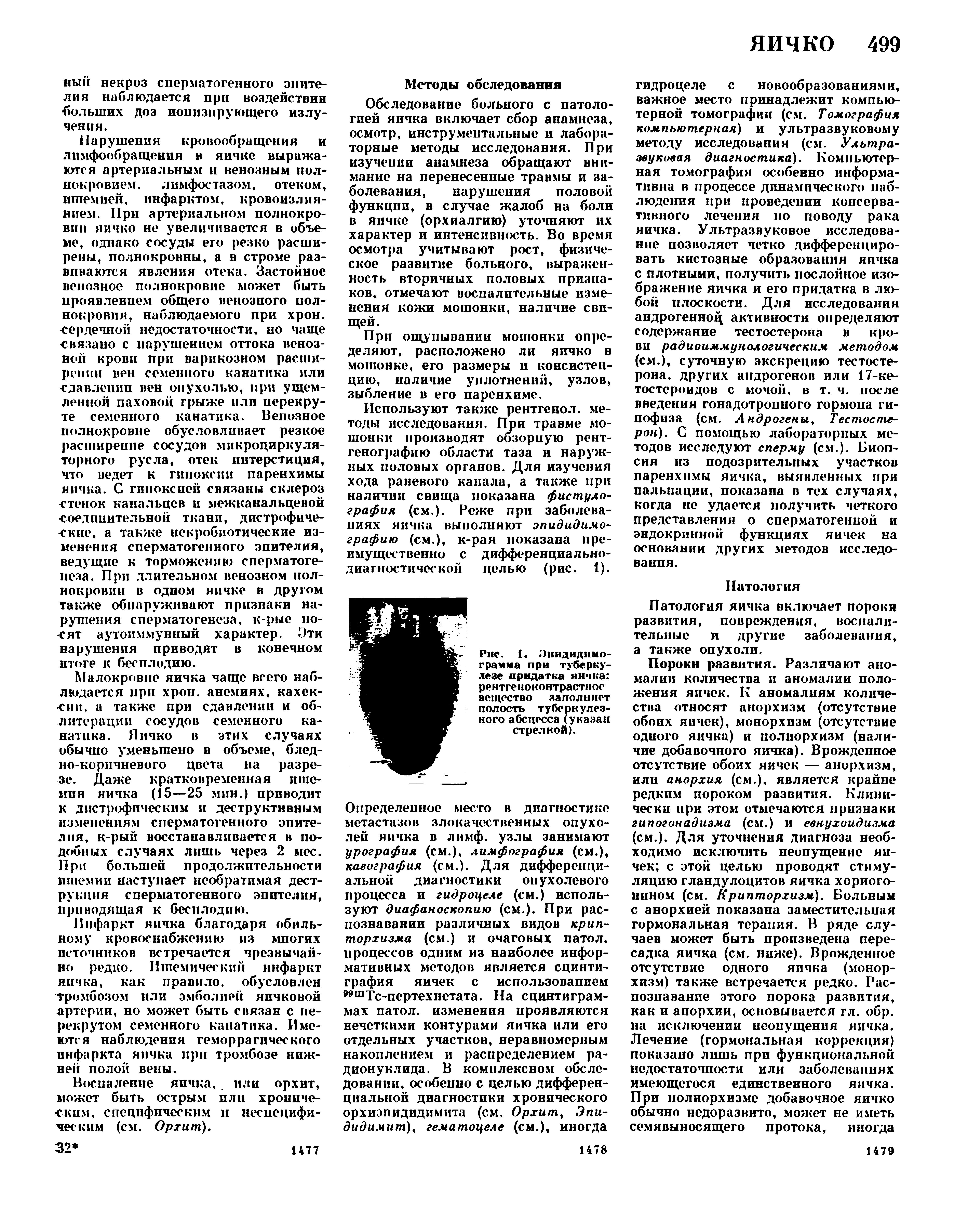 Рис. 1. Эпидидимо-грамма при туберкулезе придатка яичка рентгеноконтрастное вещество заполняет полость туберкулезного абсцесса (указан стрелкой).