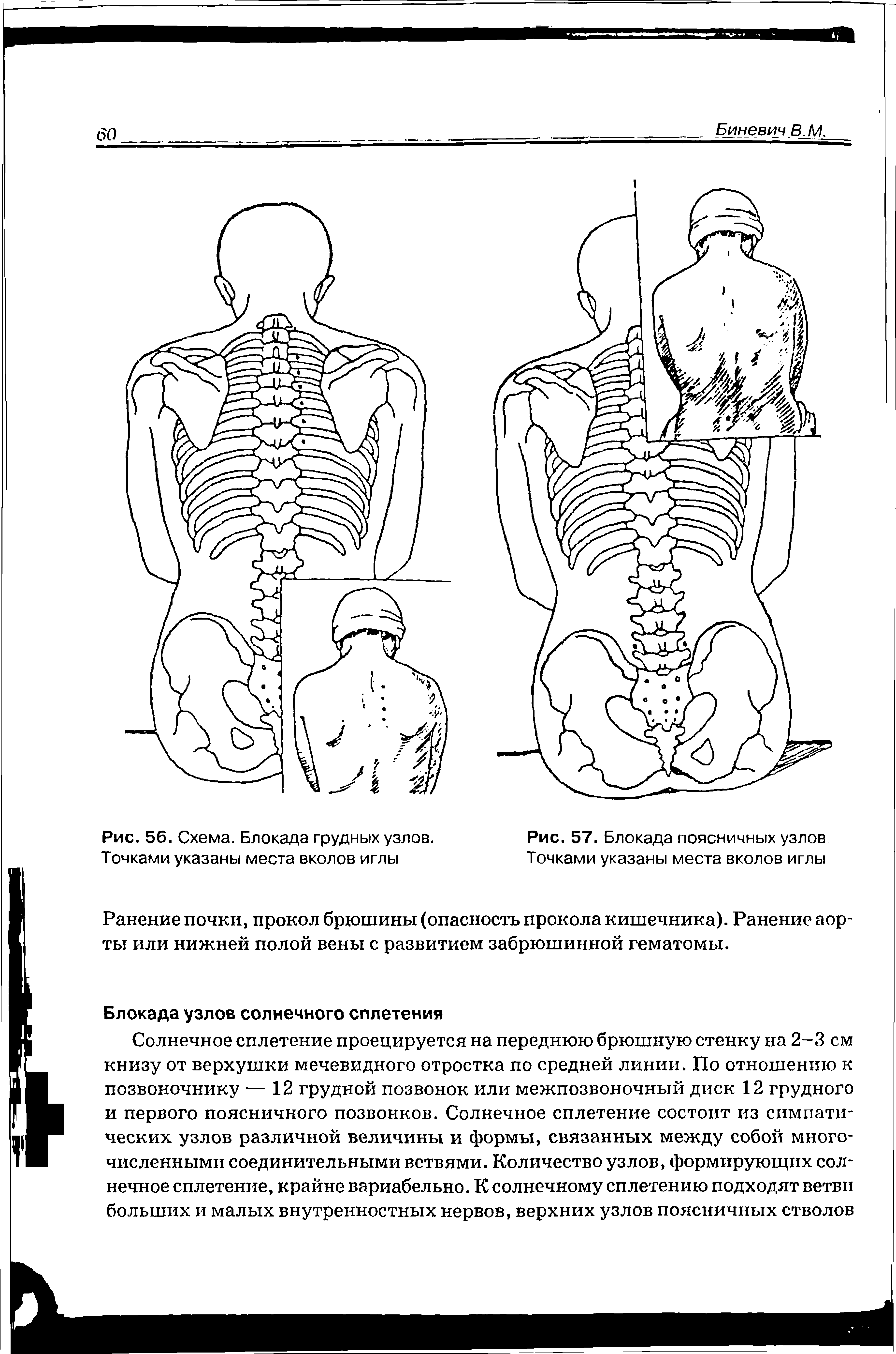 Рис. 57. Блокада поясничных узлов Точками указаны места вколов иглы...