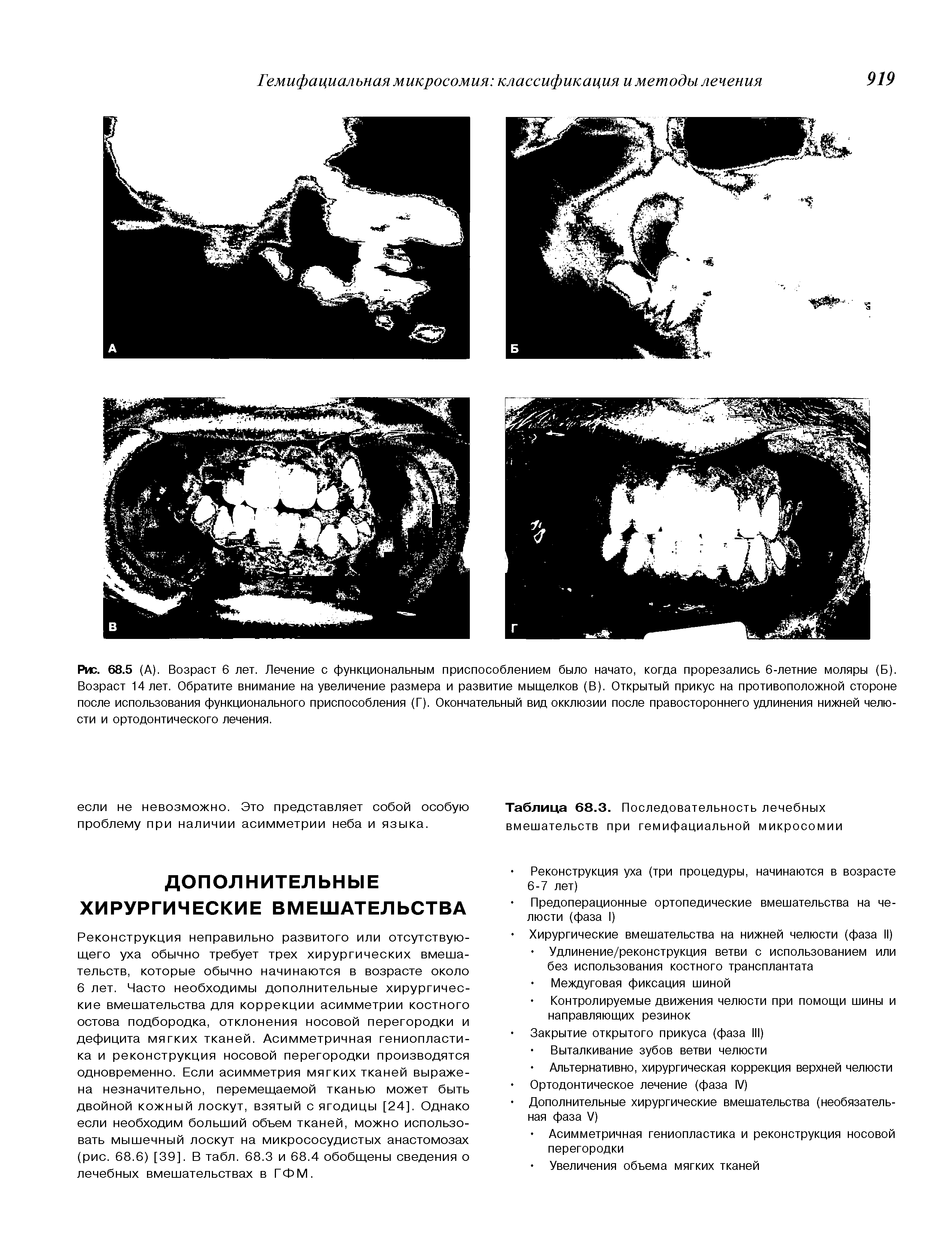 Рис. 68.5 (А). Возраст 6 лет. Лечение с функциональным приспособлением было начато, когда прорезались 6-летние моляры (Б). Возраст 14 лет. Обратите внимание на увеличение размера и развитие мыщелков (В). Открытый прикус на противоположной стороне после использования функционального приспособления (Г). Окончательный вид окклюзии после правостороннего удлинения нижней челюсти и ортодонтического лечения.