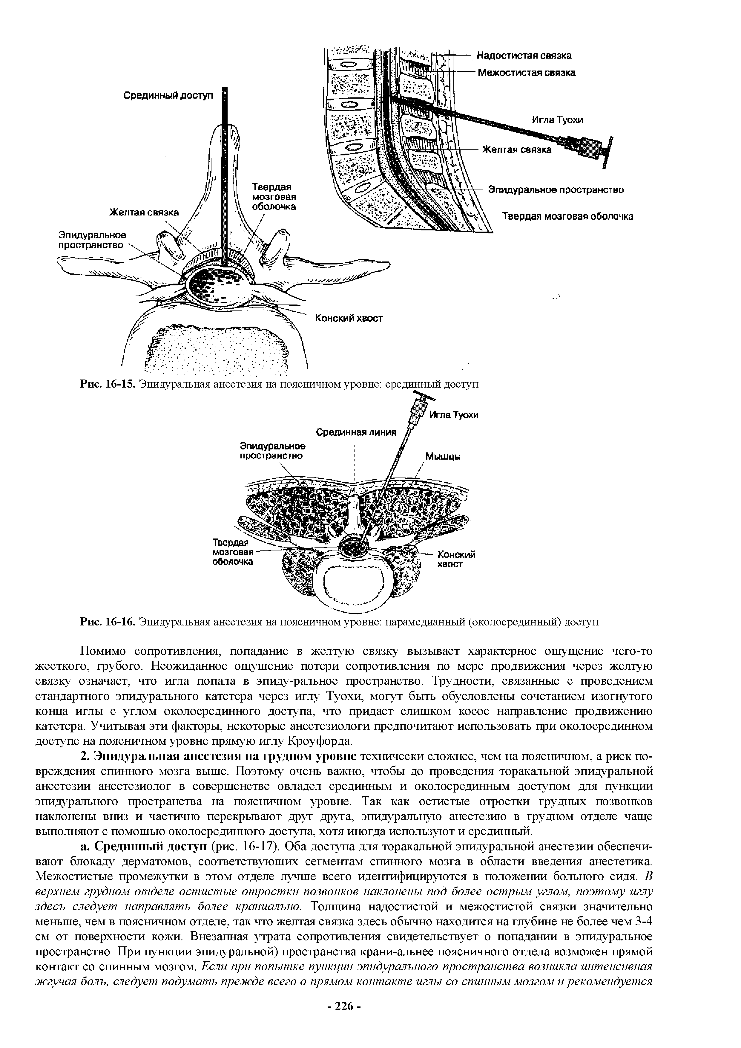 Рис. 16-15. Эпидуральная анестезия на поясничном уровне срединный доступ...