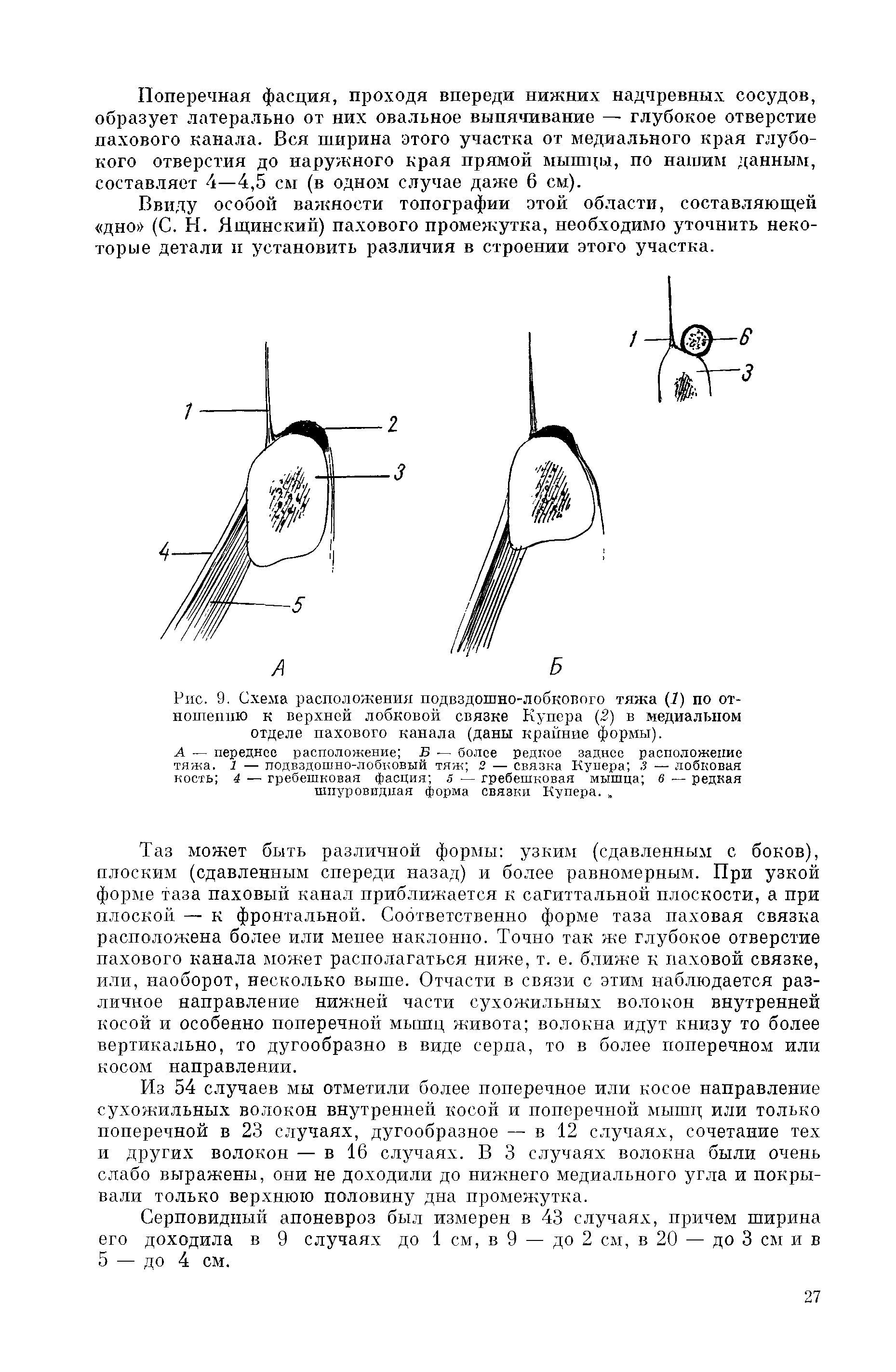 Рис. 9. Схема расположения подвздошно-лобкового тяжа (7) по отношению к верхней лобковой связке Купера (5) в медиальном отделе пахового канала (даны крайние формы).