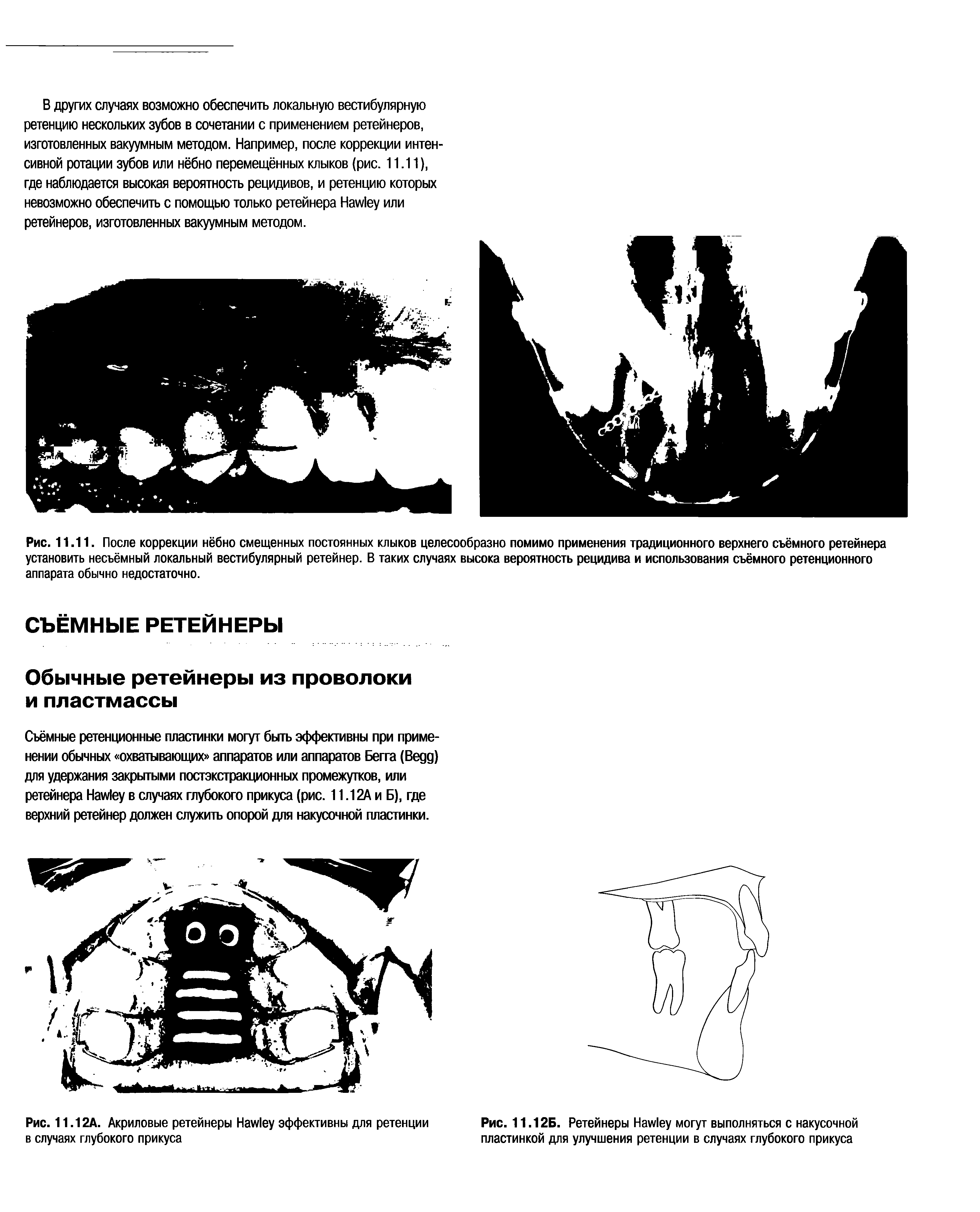 Рис. 11.12А. Акриловые ретейнеры H эффективны для ретенции в случаях глубокого прикуса...