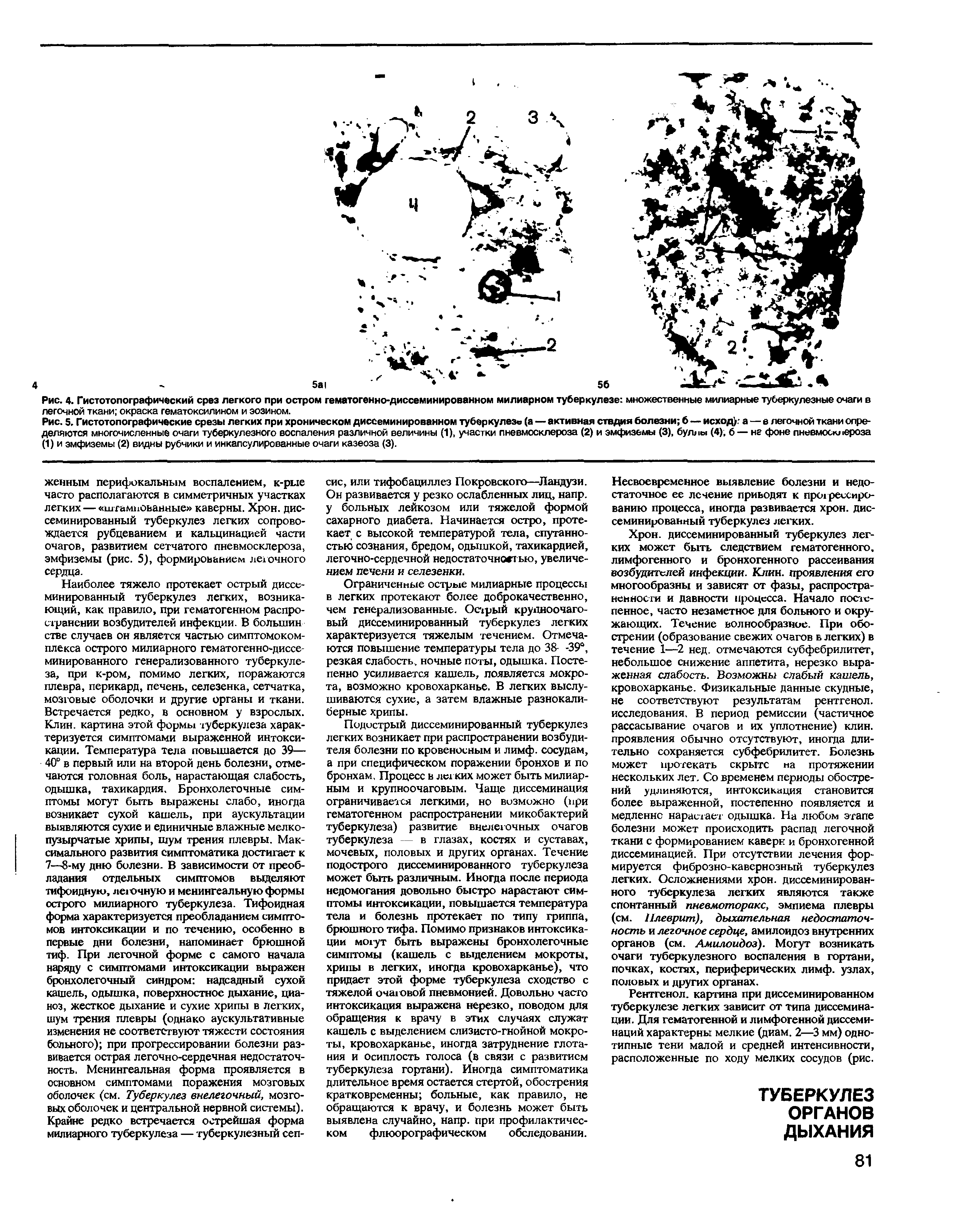 Рис. 4. Гистотопографический срез легкого при остром гематогенно-диссеминированном милиарном туберкулезе множественные милиарные туберкулезные очаги в легочной ткани окраска гематоксилином и эозином.