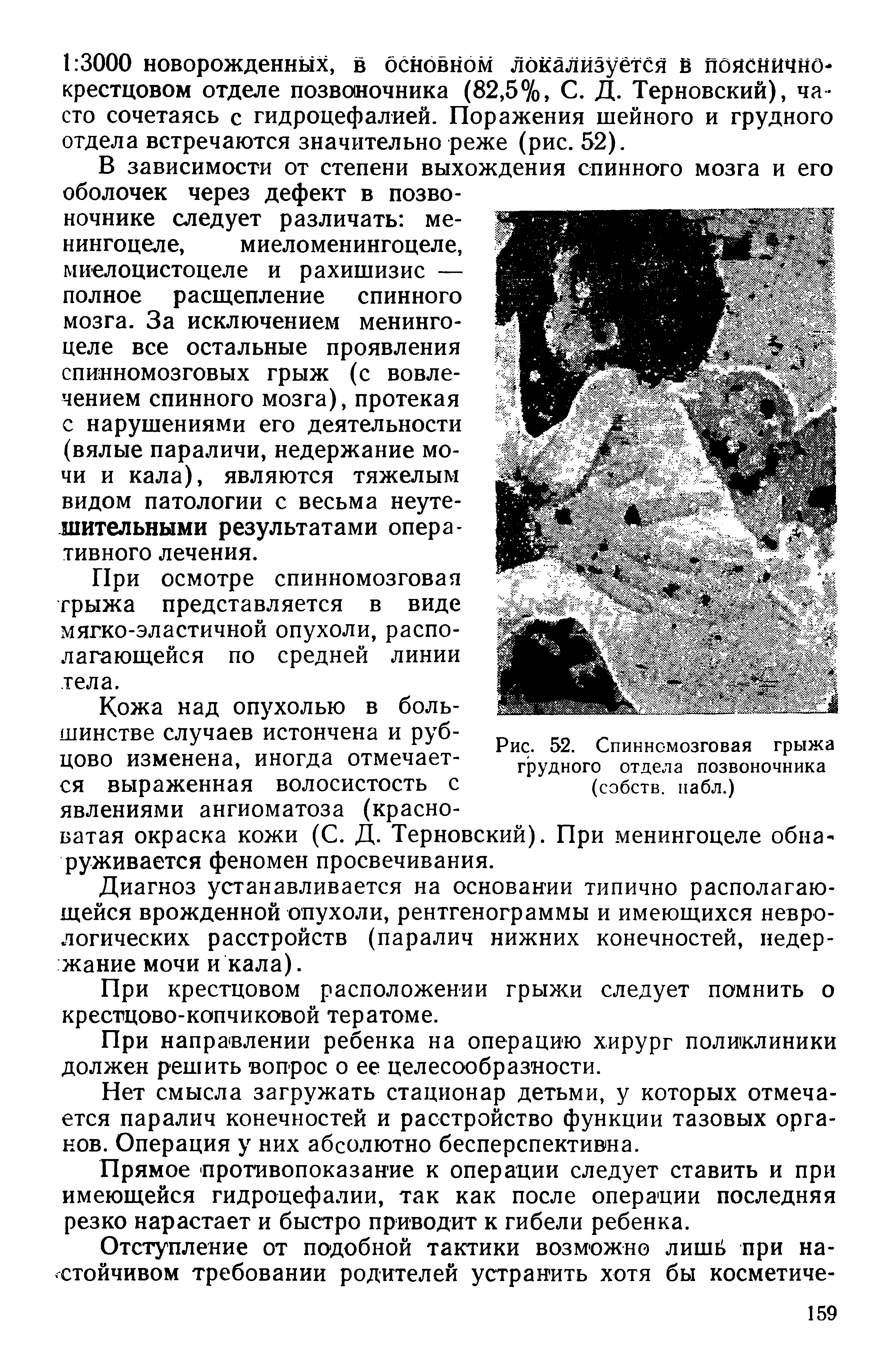 Рис. 52. Спинномозговая грыжа грудного отдела позвоночника (собств. пабл.)...