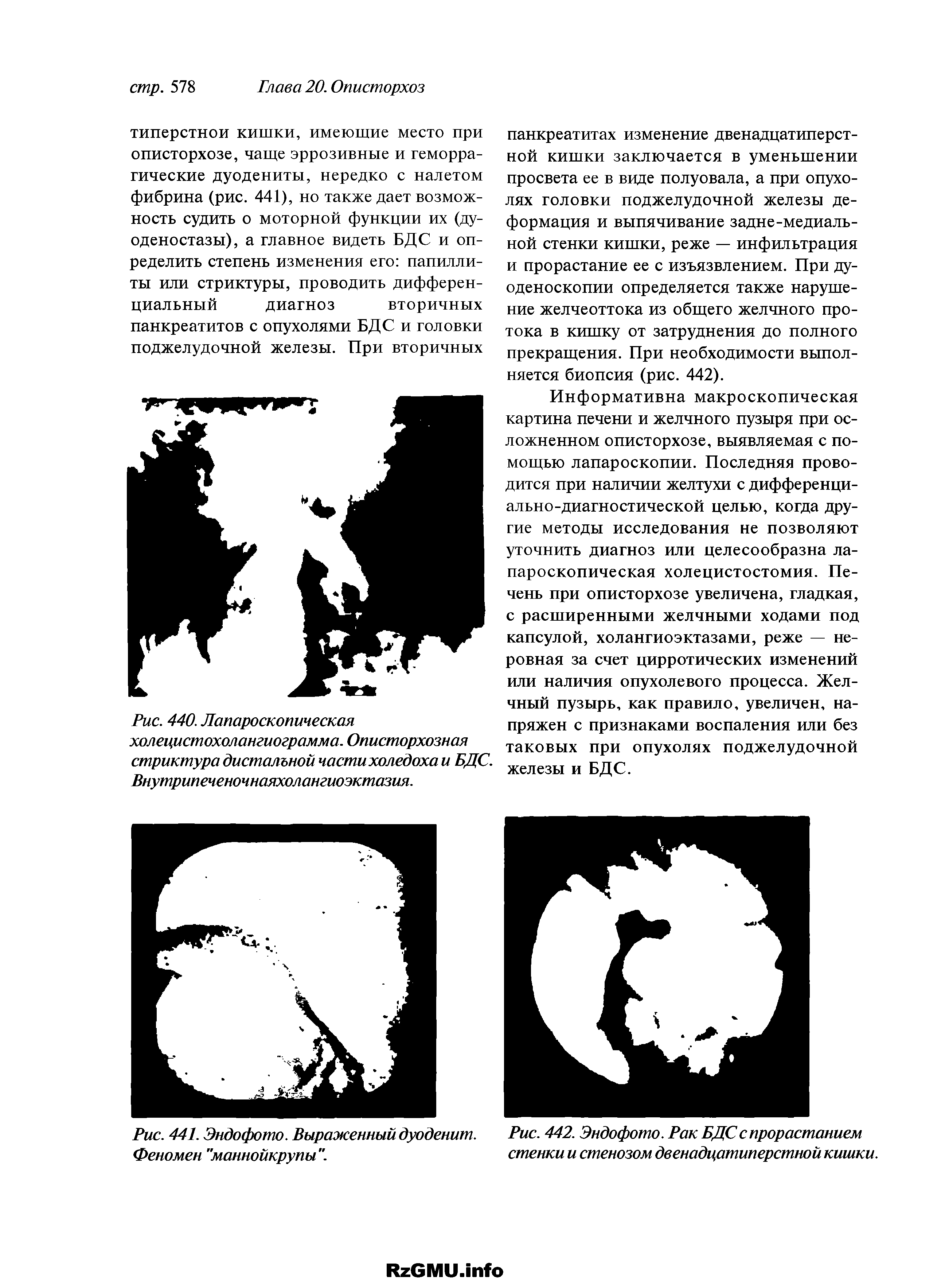 Рис. 442. Эндофото. Рак БДС с прорастанием стенки и стенозом двенадцатиперстной кишки.