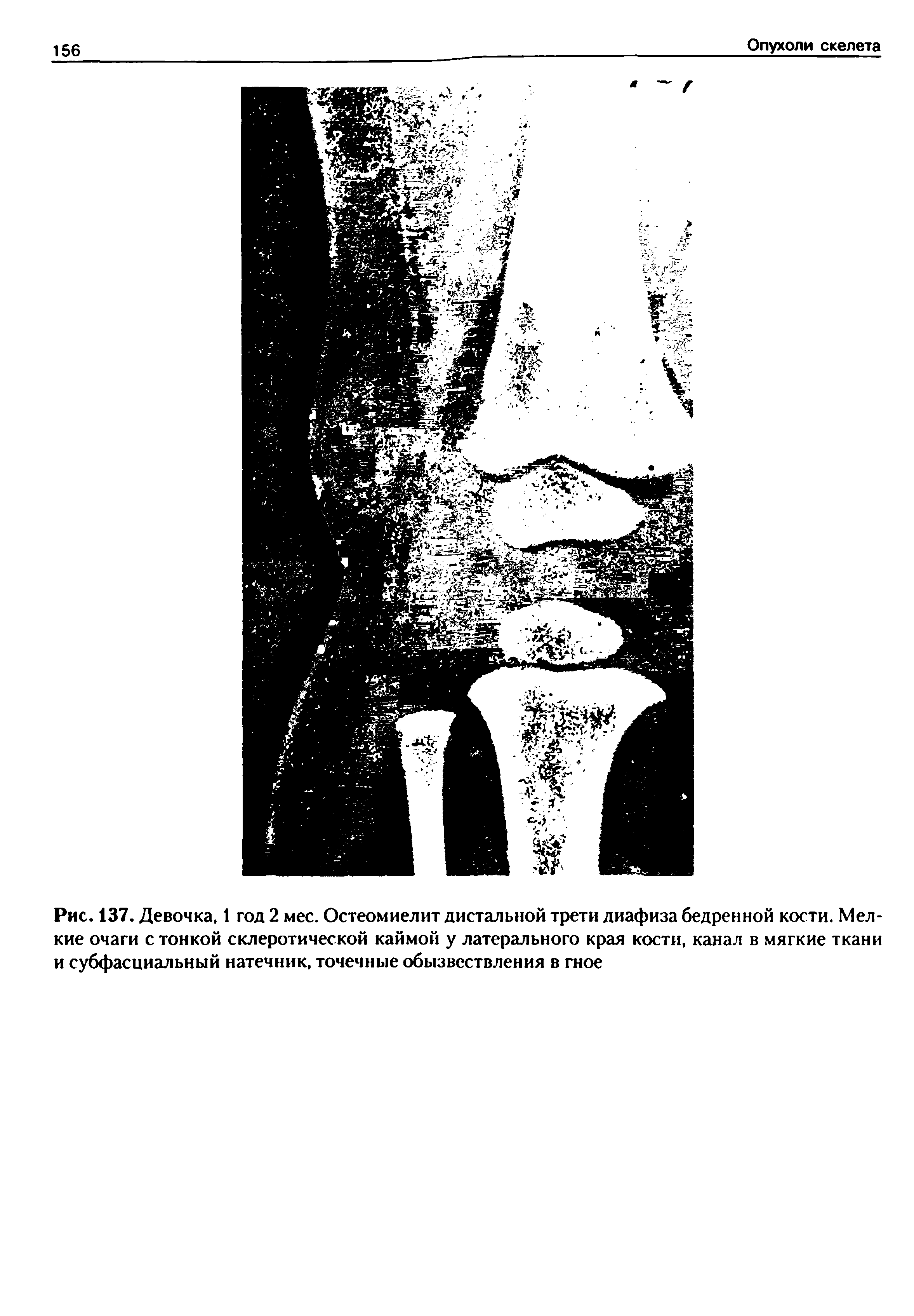 Рис. 137. Девочка, 1 год 2 мес. Остеомиелит дистальной трети диафиза бедренной кости. Мелкие очаги стойкой склеротической каймой у латерального края кости, канал в мягкие ткани и субфасциальный натечник, точечные обызвествления в гное...