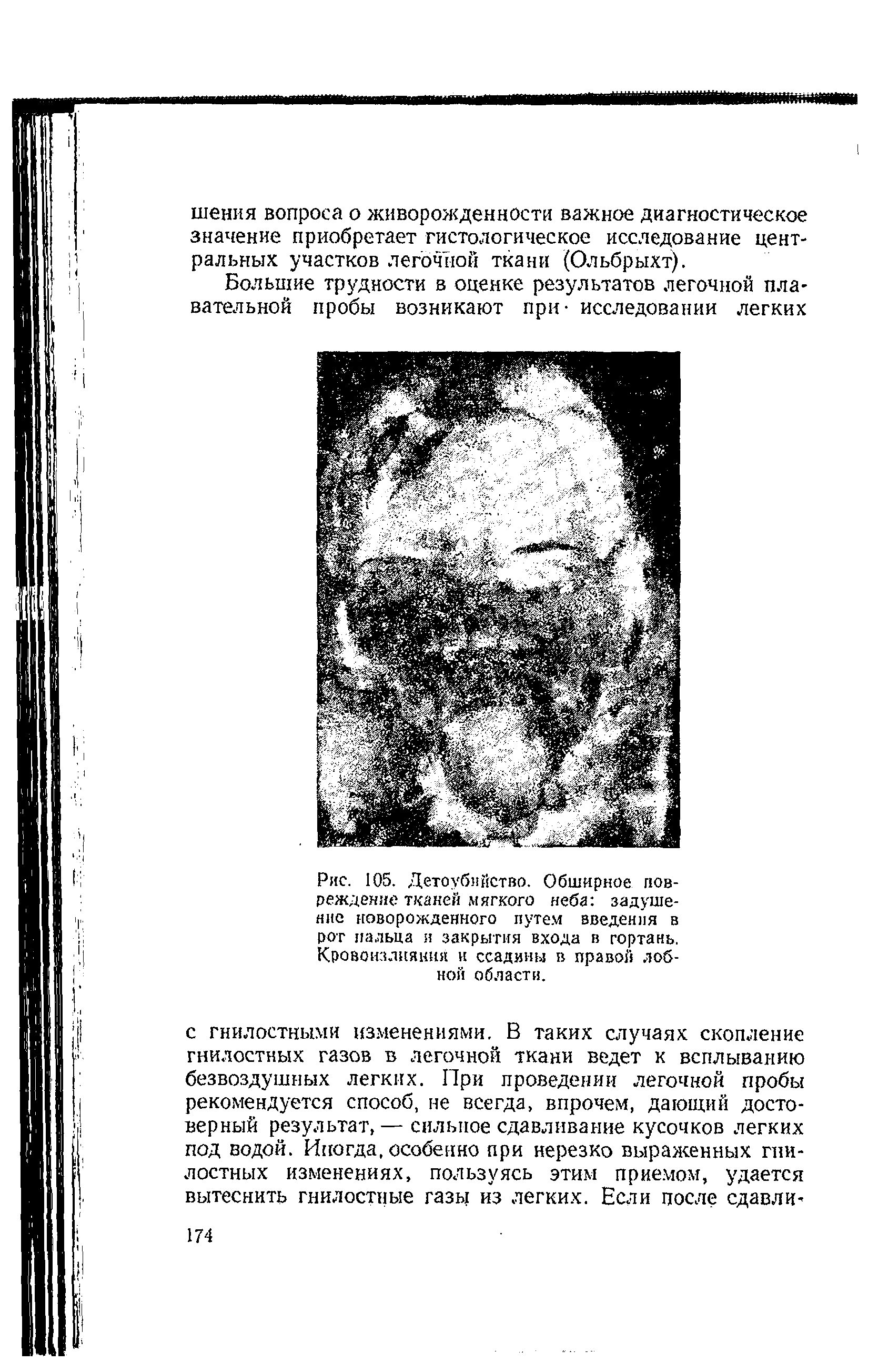 Рис. 105. Детоубийство. Обширное повреждение тканей мягкого неба задушение новорожденного путем введения в рот пальца я закрытия входа в гортань. Кровоизлияния и ссадины в правой лобной области.