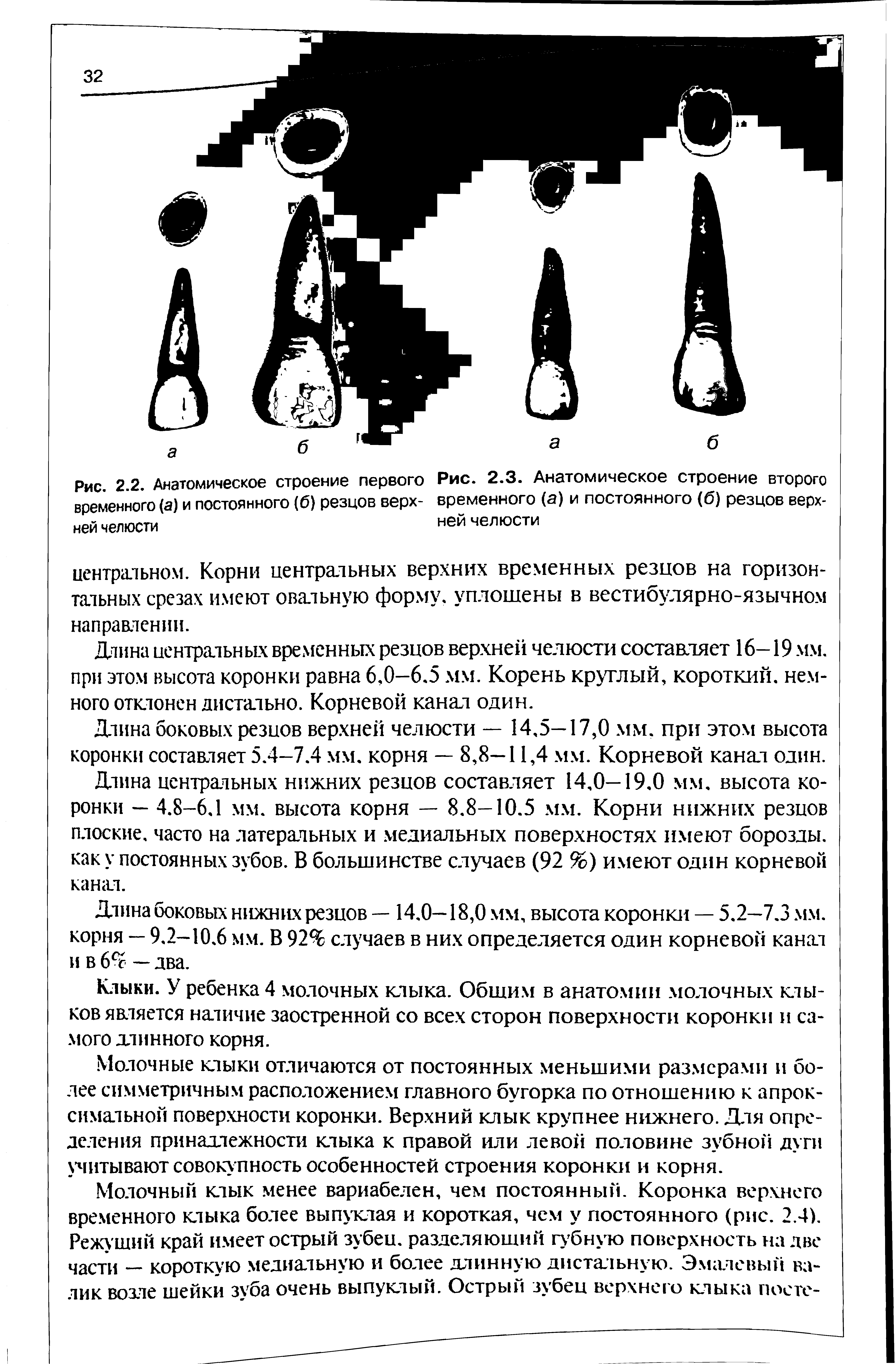 Рис. 2.3. Анатомическое строение второго временного (а) и постоянного (б) резцов верхней челюсти...