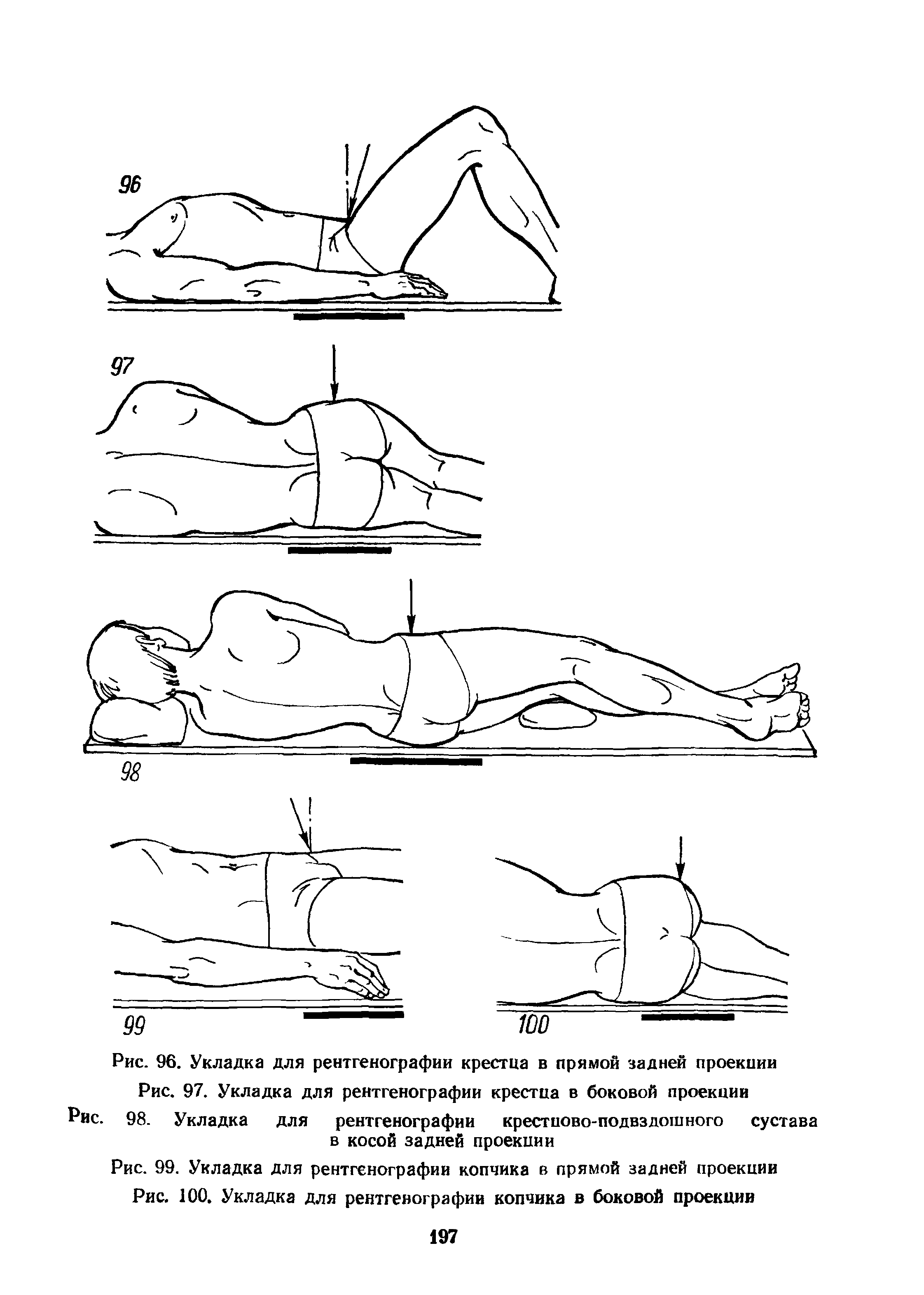 Рис. 99. Укладка для рентгенографии копчика в прямой задней проекции Рис. 100. Укладка для рентгенографии копчика в боковой проекции...