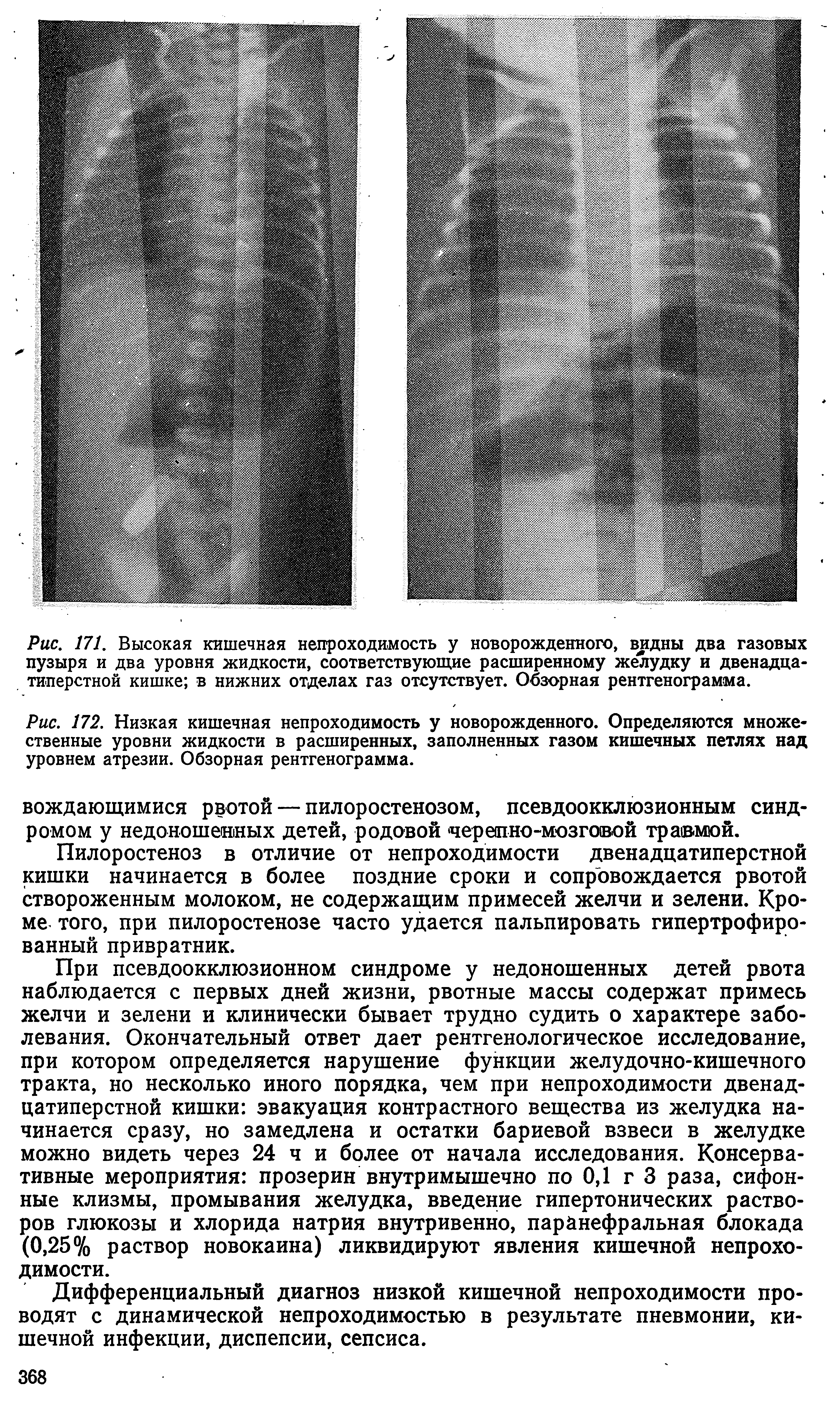 Рис. 172. Низкая кишечная непроходимость у новорожденного. Определяются множественные уровни жидкости в расширенных, заполненных газом кишечных петлях над уровнем атрезии. Обзорная рентгенограмма.