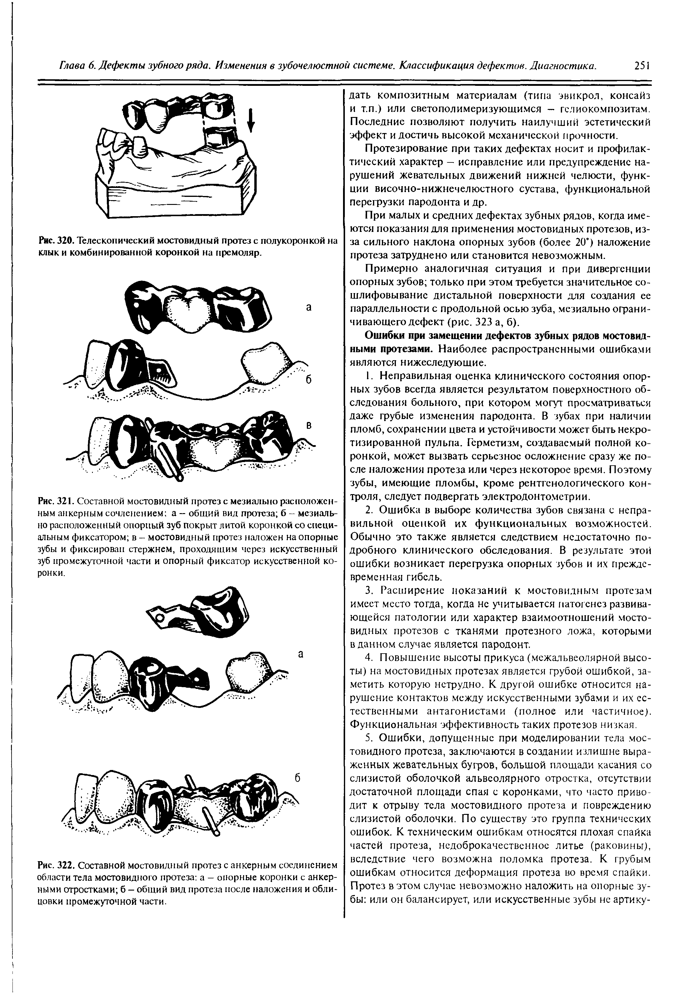 Рис. 321. Составной мостовидный протез с мезиально расположенным анкерным сочленением а - общий вид протеза б - мезиально расположенный опорный зуб покрыт литой коронкой со специальным фиксатором в - мостовидный протез наложен на опорные зубы и фиксирован стержнем, проходящим через искусственный зуб промежуточной части и опорный фиксатор искусственной коронки.