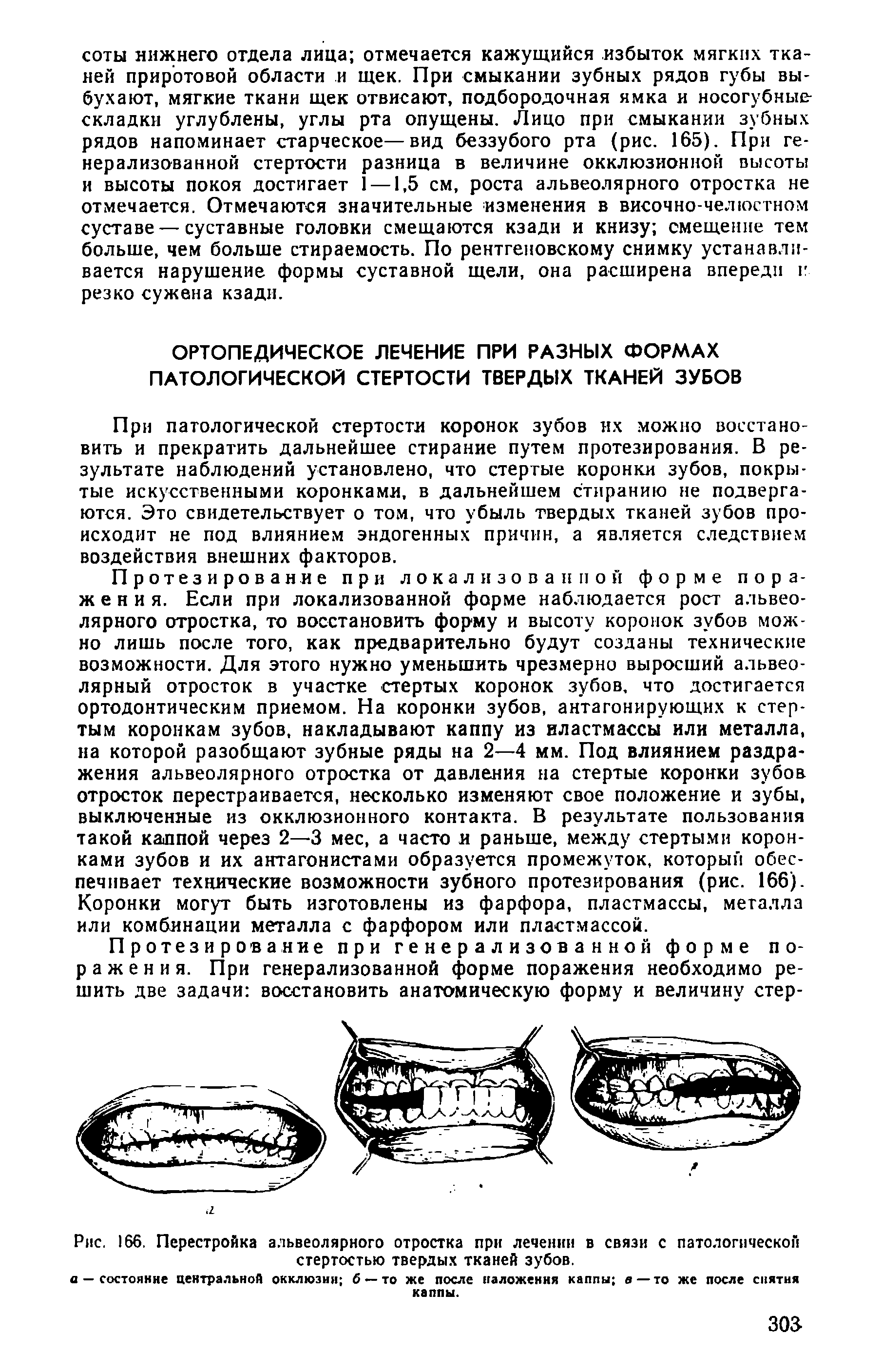 Рис. 166. Перестройка альвеолярного отростка при лечении в связи с патологической стертостью твердых тканей зубов.