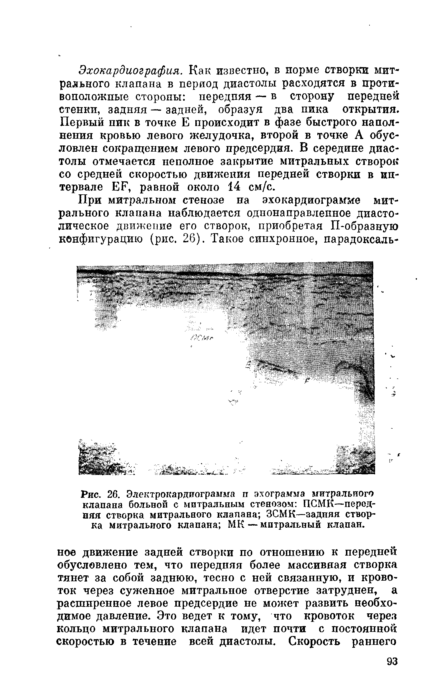 Рис. 26. Электрокардиограмма п эхограмма митрального клапана больной с митральным стенозом ПСМК—передняя створка митрального клапана ЗСМК—задняя створка митрального клапана МК — митральный клапан.