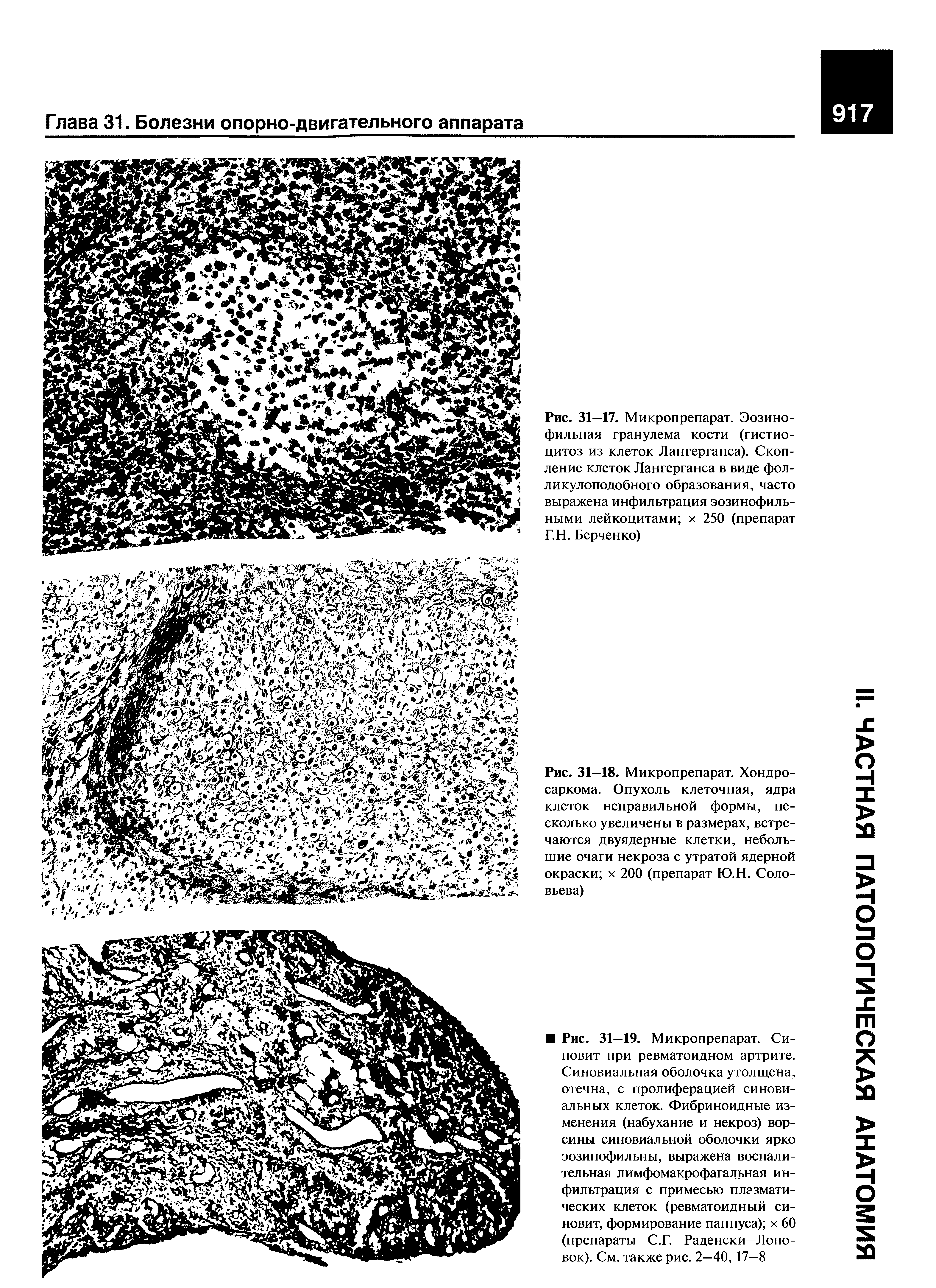 Рис. 31—18. Микропрепарат. Хондросаркома. Опухоль клеточная, ядра клеток неправильной формы, несколько увеличены в размерах, встречаются двуядерные клетки, небольшие очаги некроза с утратой ядерной окраски х 200 (препарат Ю.Н. Соловьева)...