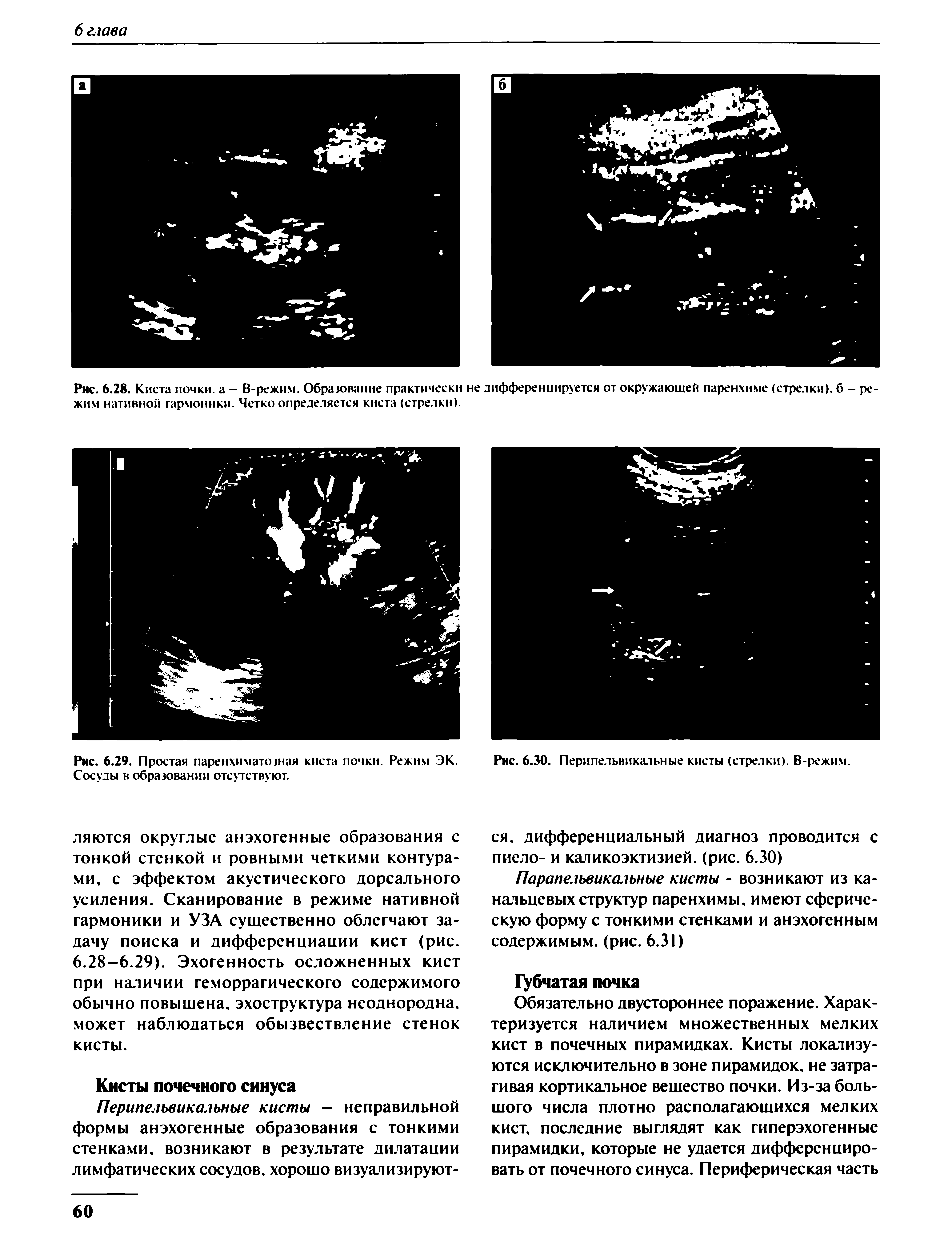 Рис. 6.28. Киста почки, а - В-режим. Образование практически не дифференцируется от окружающей паренхиме (стрелки), б - режим нативной гармоники. Четко определяется киста (стрелки).